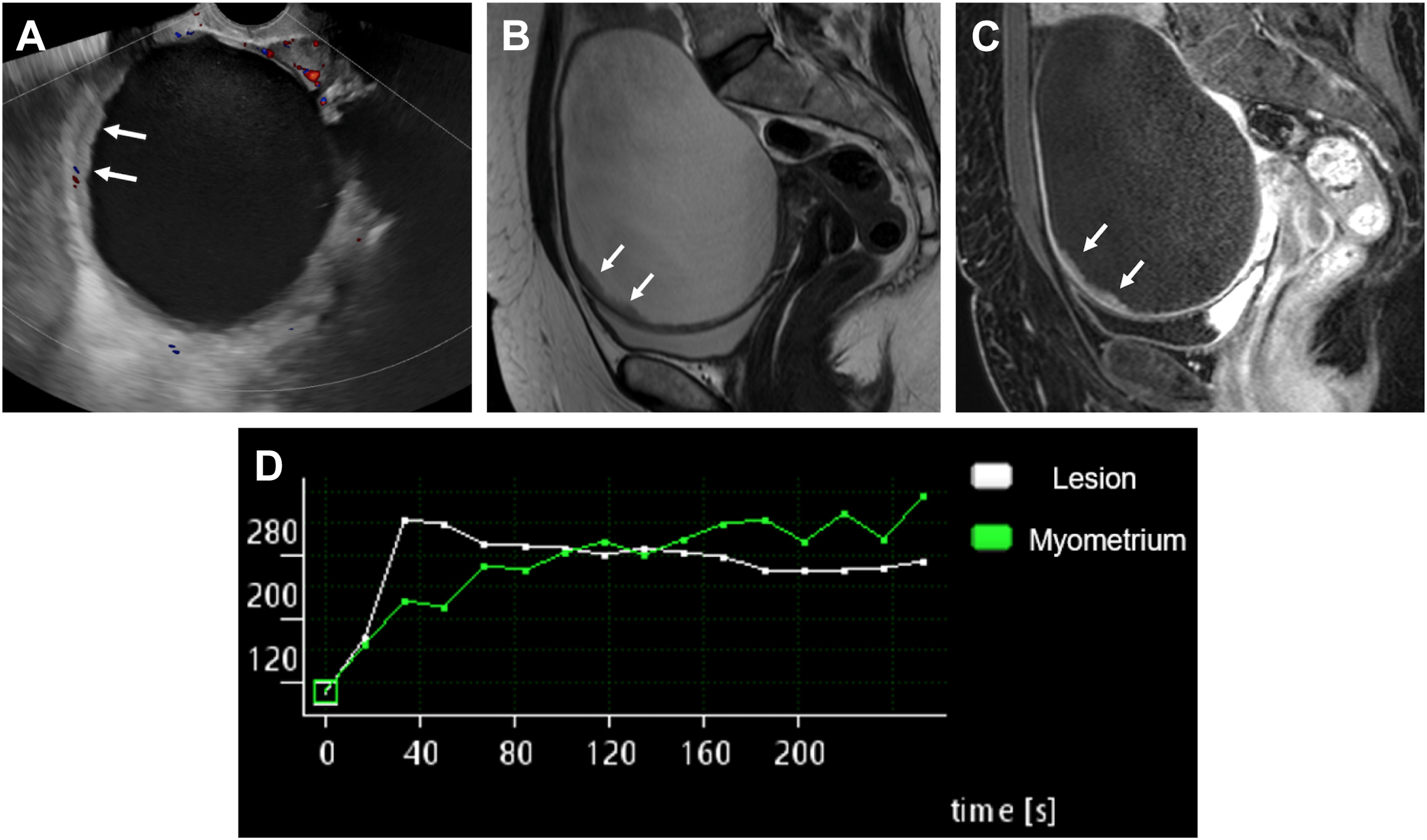 Four panels with ultrasound and M R I shows a 12-centimeter unilocular cyst with a solid mural component and high-risk contrast enhancement in a 63-year-old patient.