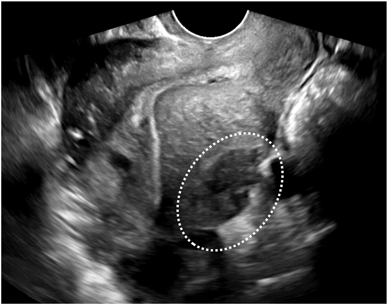A transvaginal ultrasound image shows a hypoechoic soft-tissue plaque along the posterior uterine serosa, outlined by a dotted oval, consistent with deep endometriosis.