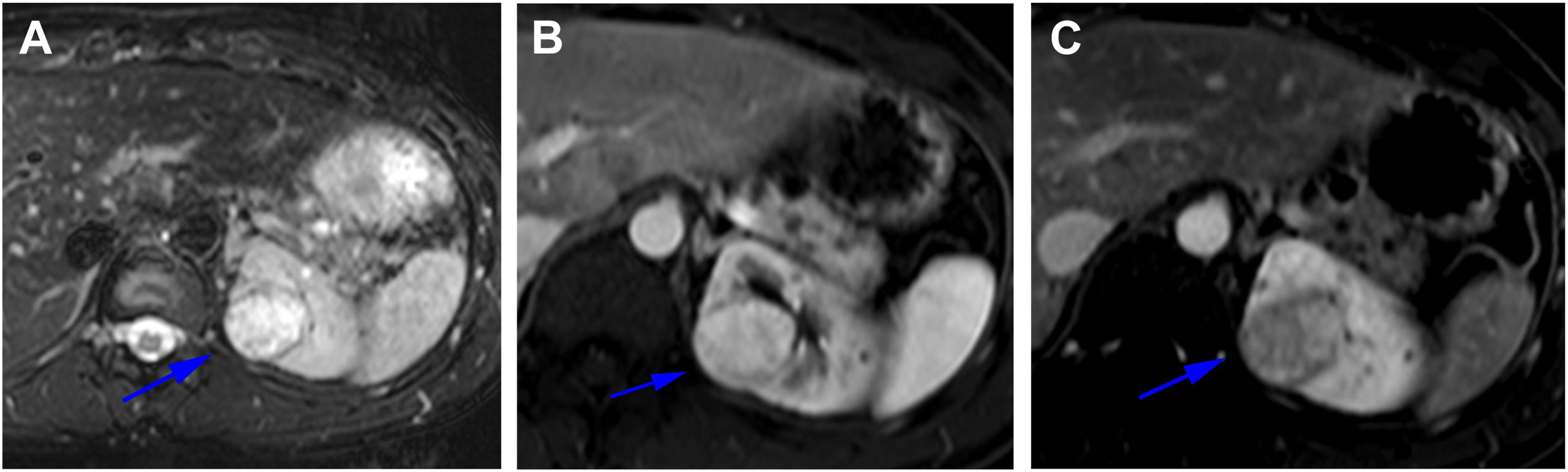 Three axial M R I shows a well-circumscribed, hypervascular, clear cell renal cell carcinoma mass in the left kidney of a 26-year-old male with von Hippel-Lindau disease.