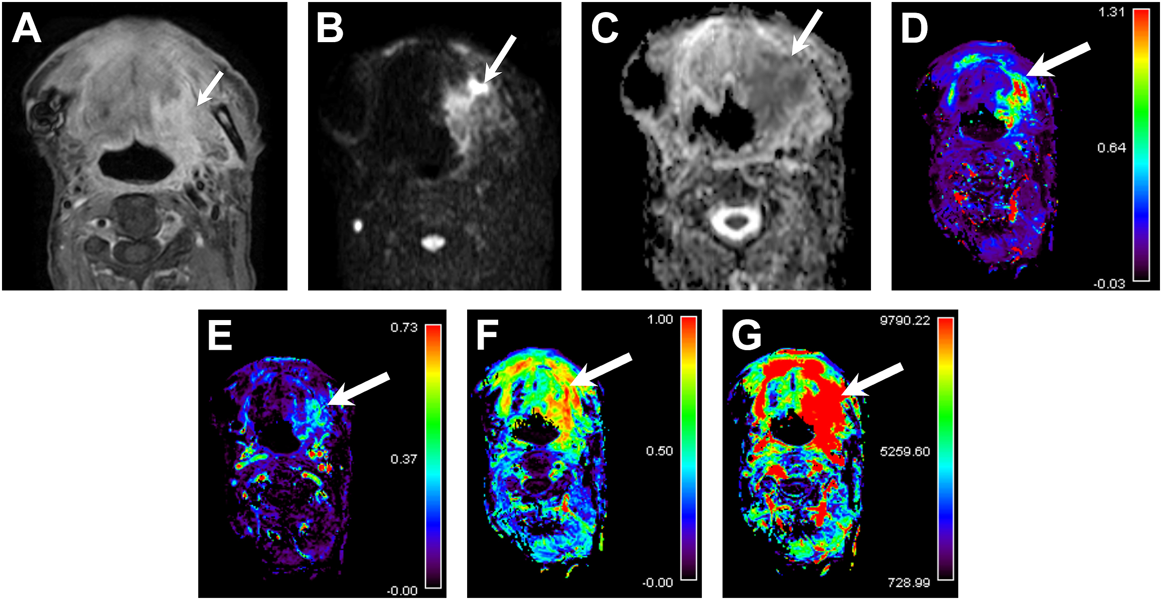 A set of seven axial M R I scans shows a tongue lesion marked by arrows using conventional, diffusion-weighted, A D C, and color-coded parameter maps from functional imaging with scales.