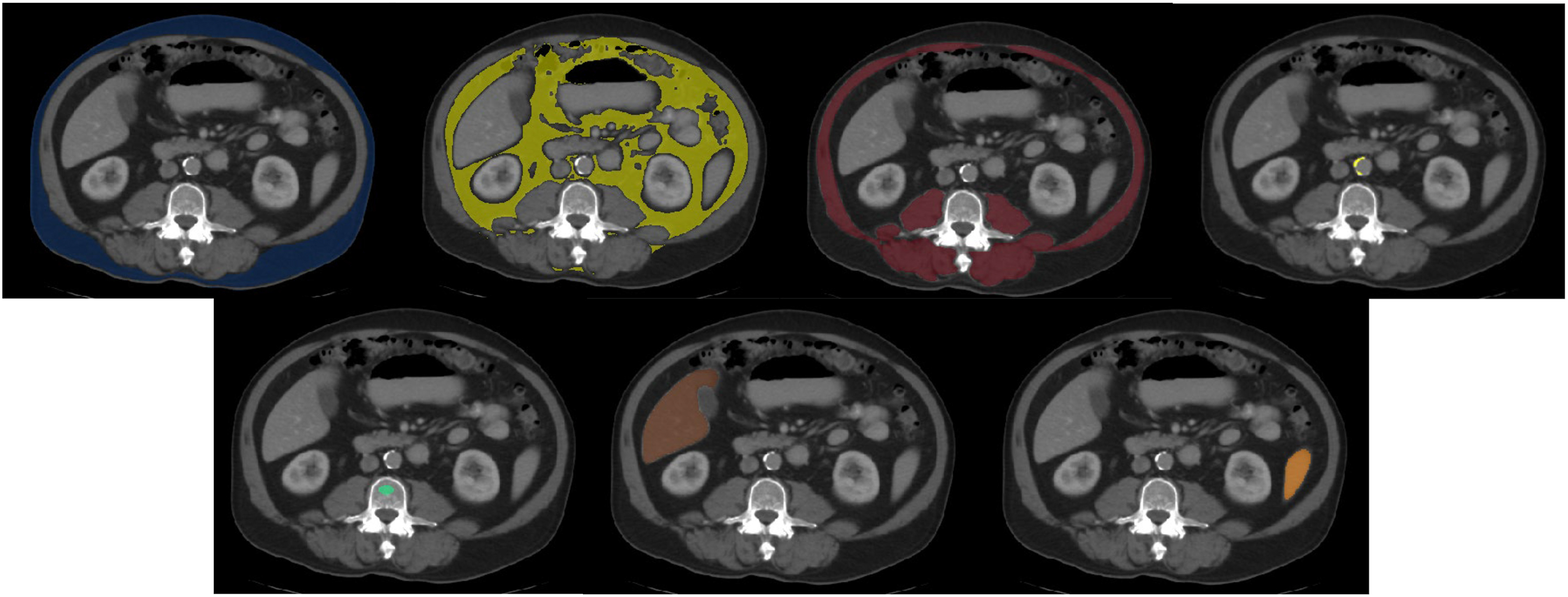 A grid of seven axial computed tomography images at the L 3 vertebral level shows automated deep learning segmentation of fat, muscle, abdominal aortic calcification, bone, liver, and spleen using color overlays.