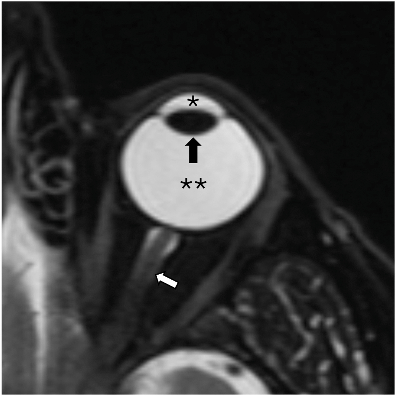 A magnetic resonance scan of the globe in an axial T 2-weighted sequence showing the lens, anterior chamber, posterior chamber, and optic nerve.