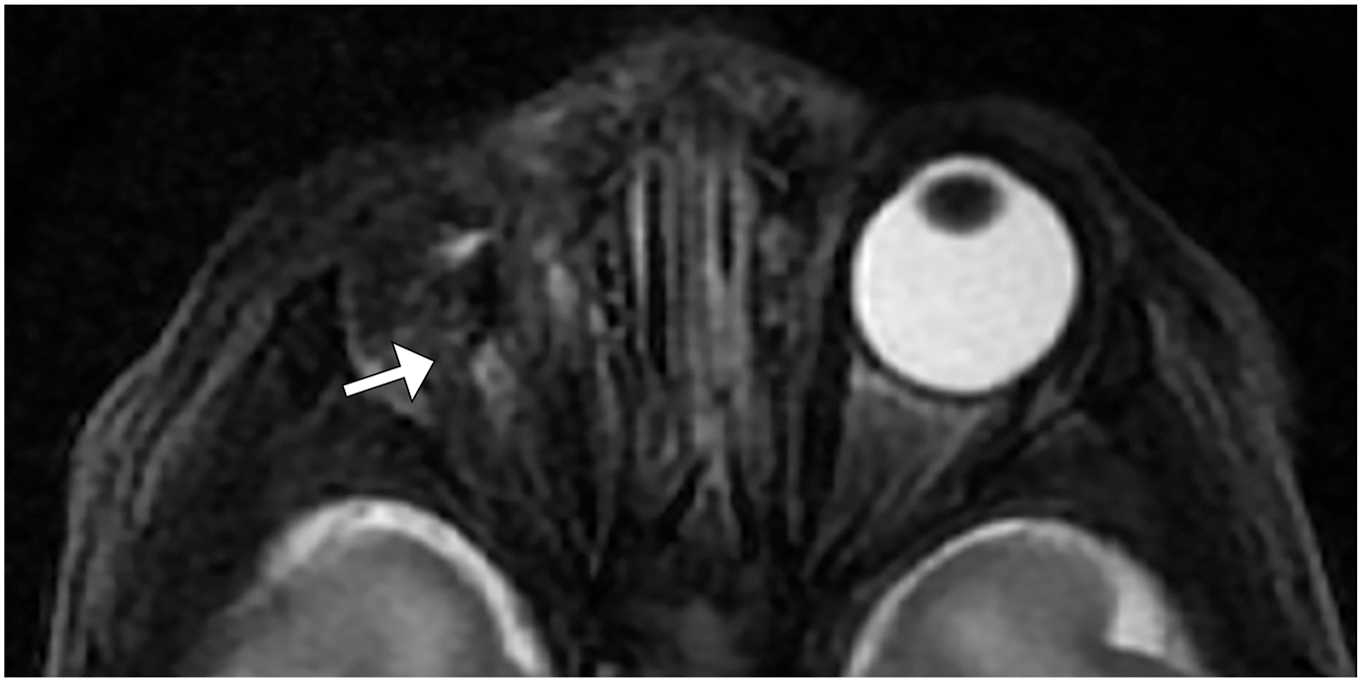 An axial T2-weighted fat-suppressed M R I shows right anophthalmia with absent ocular tissue and a dysplastic optic nerve indicated by an arrow.
