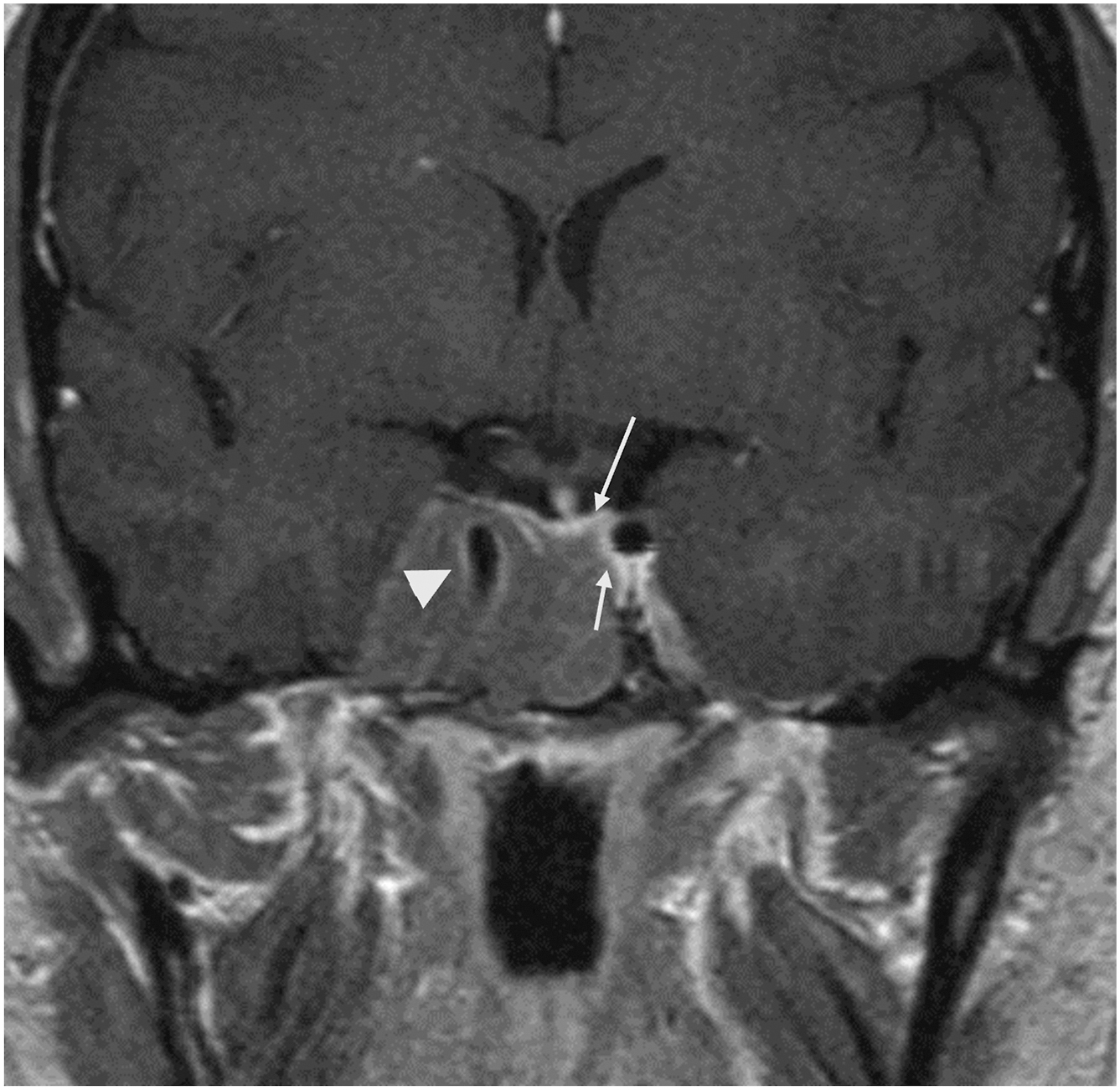 A coronal contrast-enhanced T 1 W M R I shows a large pituitary adenoma infiltrating the right cavernous sinus and encasing the artery, while the left pituitary gland and venous space remain normal.