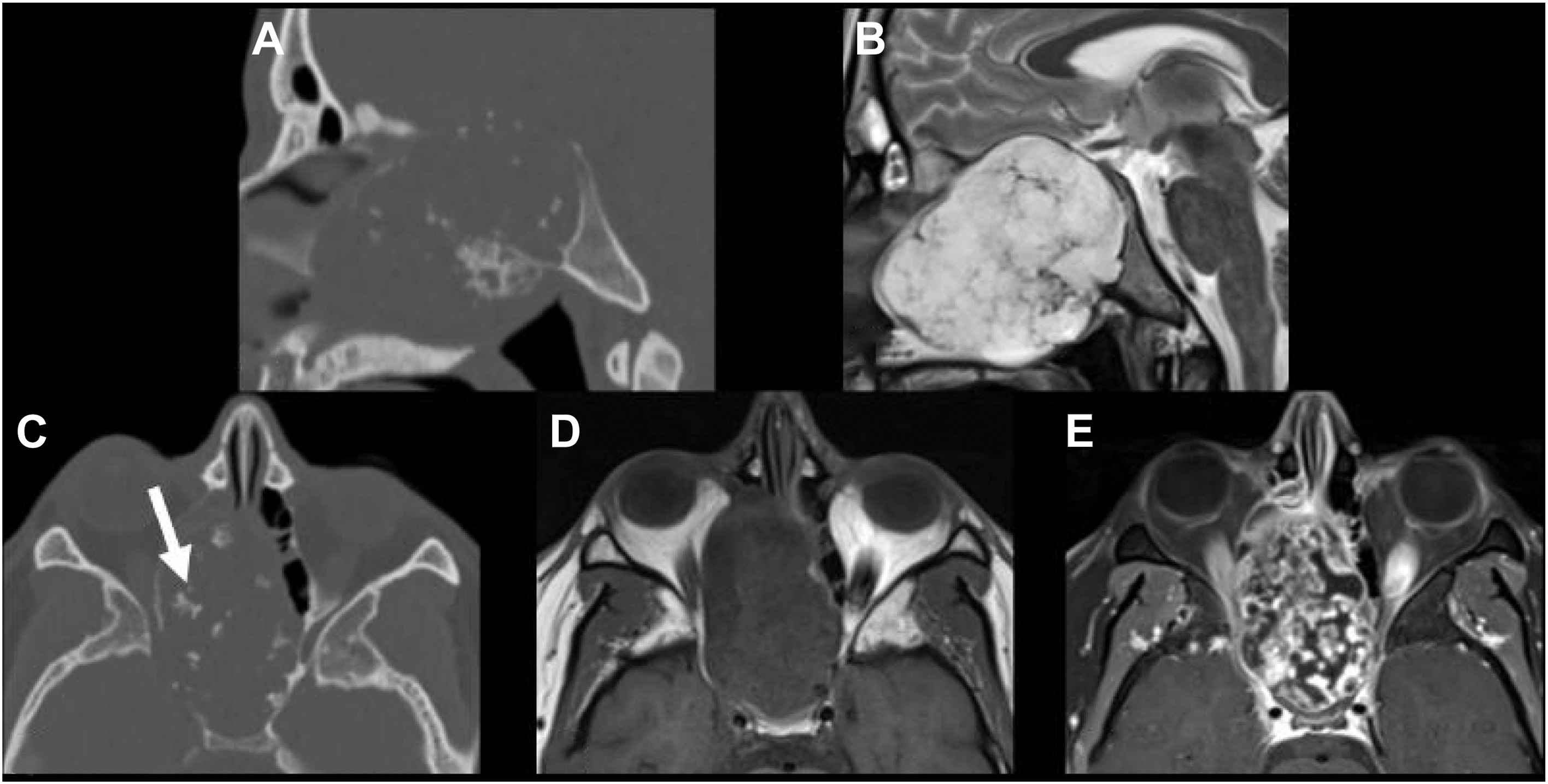 A set of five scans with C T and M R I of a sphenoid chondrosarcoma shows a destructive skull base lesion with internal rings and arcs, hyperintense T 2-signal, and heterogeneous enhancement.
