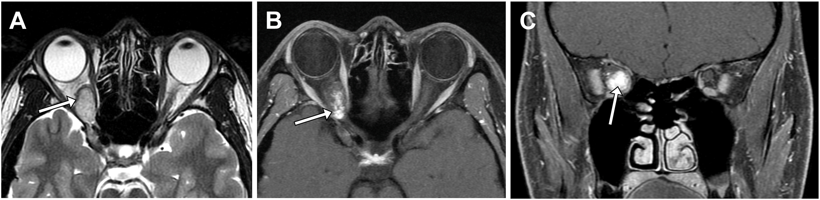 A three-panel magnetic resonance scan shows a cavernous venous malformation in the right intraconal space, demonstrating progressive patchy to uniform enhancement before radiation therapy.