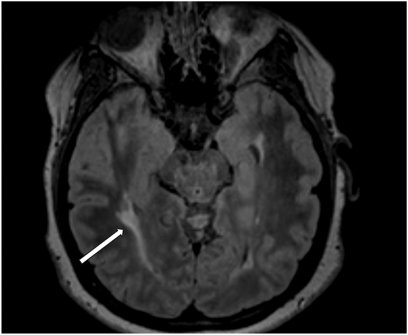 A magnetic resonance imaging scan shows multiple sclerosis lesions involving the optic radiations, featuring an arrow pointing to an old demyelination lesion on the right side.