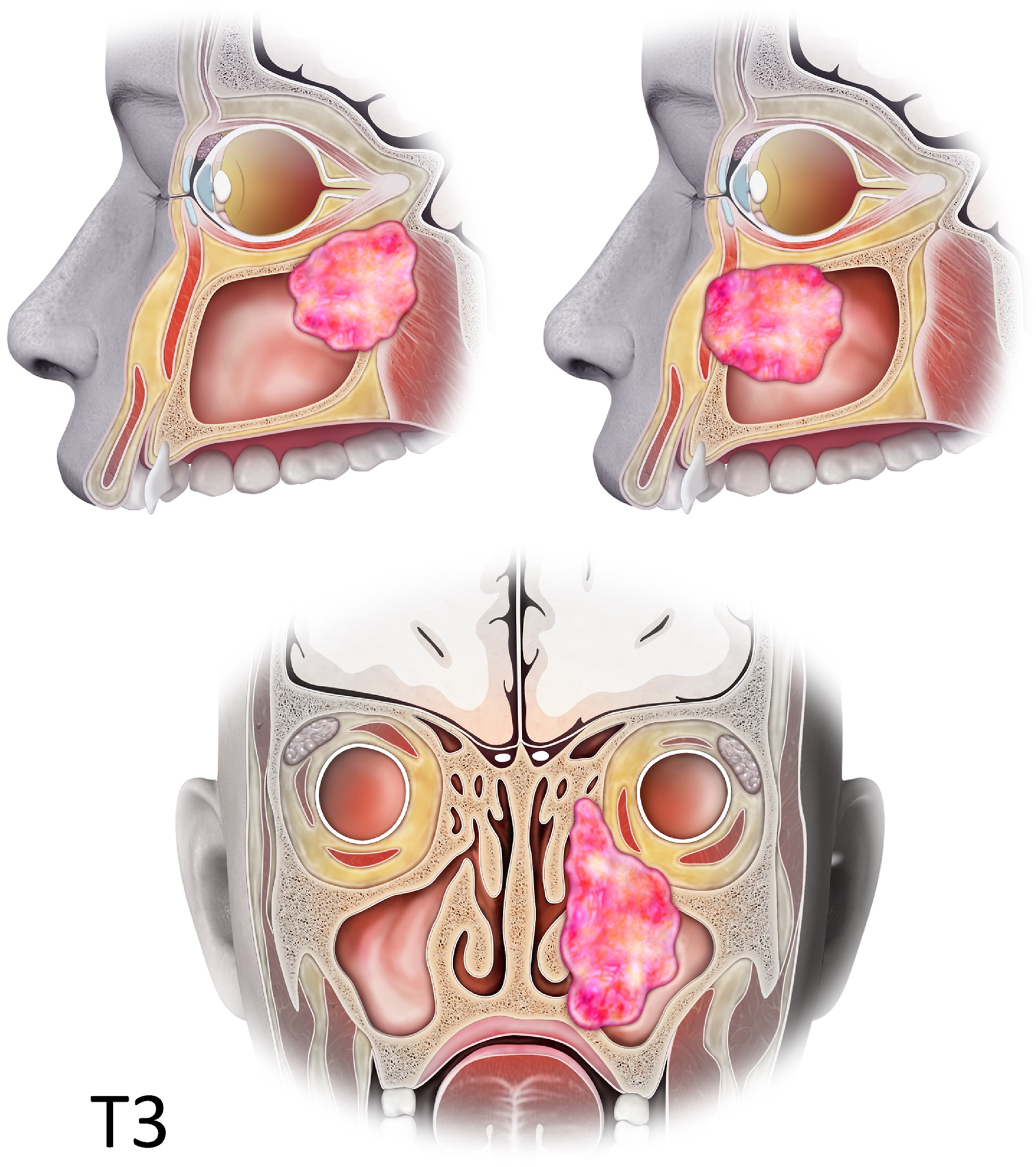 A labeled medical illustration shows T 3 stage maxillary sinus tumor extending into adjacent anatomical structures.