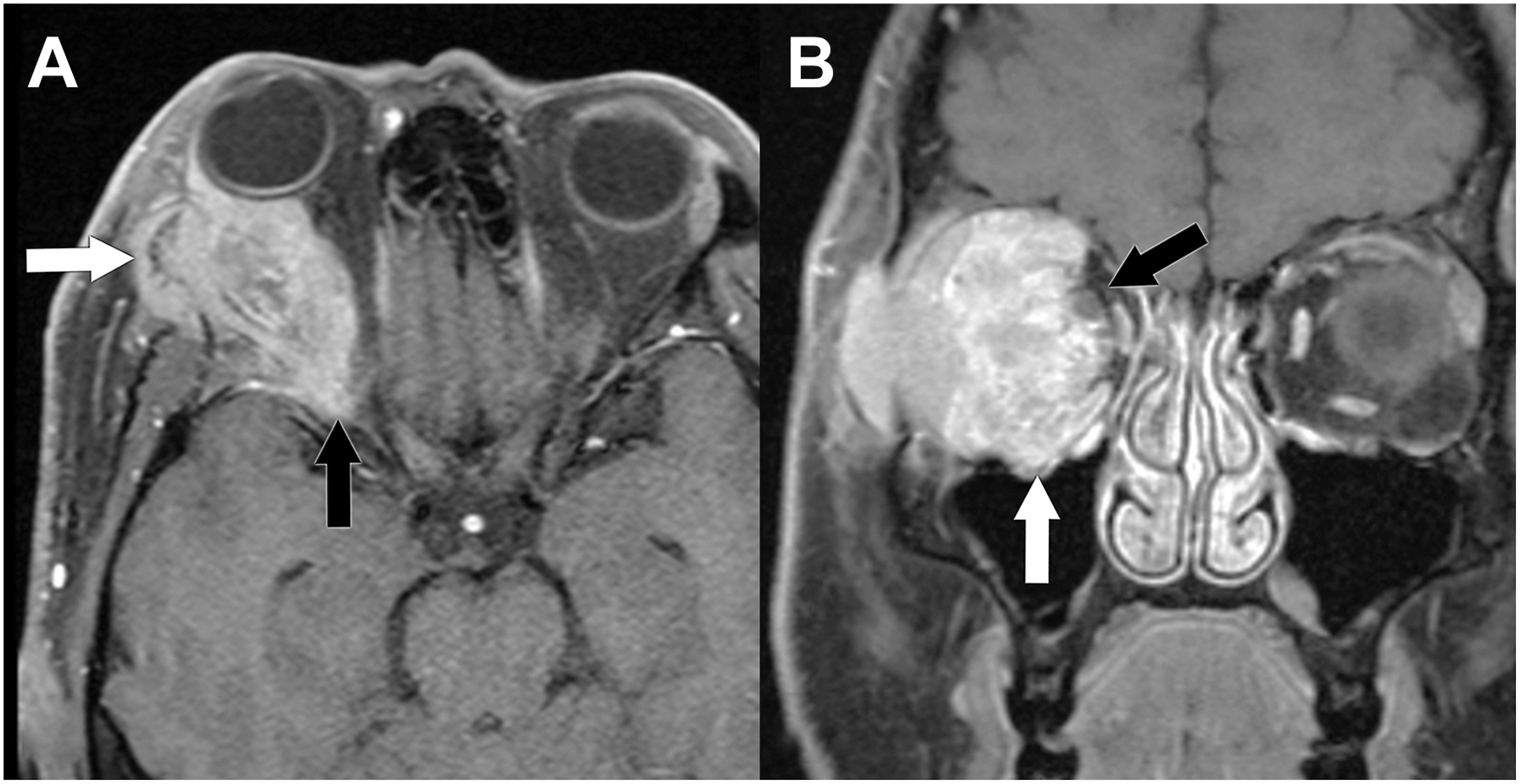 A two-part magnetic resonance imaging scan shows a large lacrimal gland adenoid cystic carcinoma in the right orbit with an extensive tumor infiltration into surrounding bones and spaces.