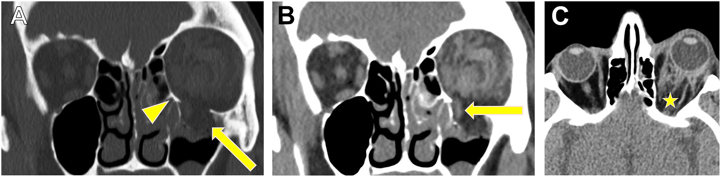 A three-panel computed tomography scan shows a left orbital floor blowout fracture featuring muscle entrapment and retrobulbar hemorrhage, highlighted by arrows and a star.