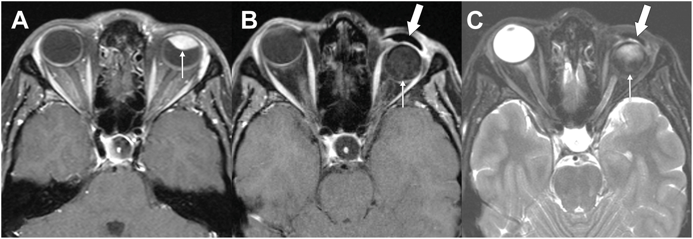 A set of three axial magnetic resonance imaging scans demonstrates a left uveal melanoma before surgery and post-operative views that show an orbital implant and an ocular prosthesis.