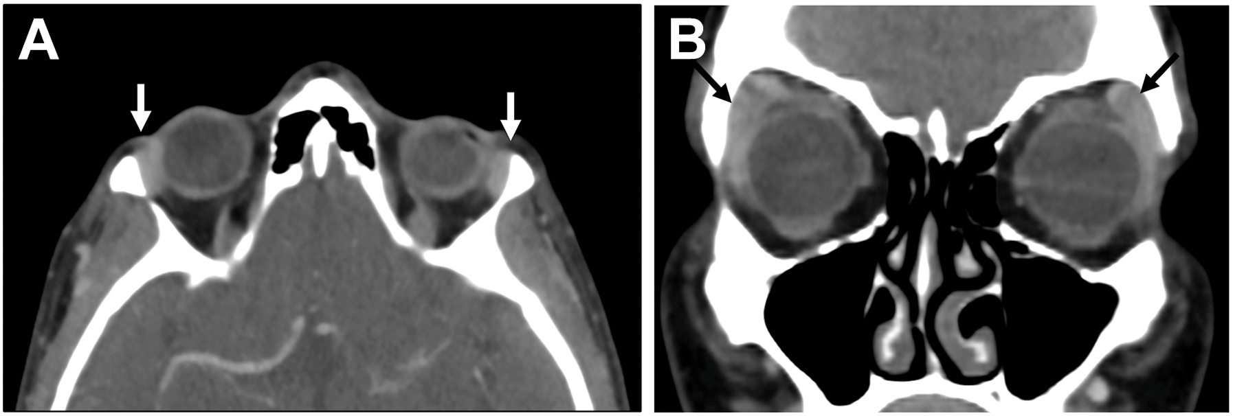 A set of two computed tomography scans of normal lacrimal glands shows axial and coronal contrast-enhanced scans with solid arrows pointing to the symmetric glands in the superolateral orbits.