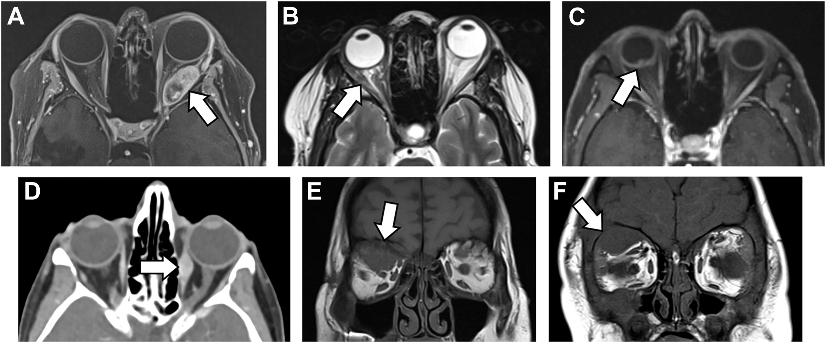 Six M R I scans labeled A through F show different instances of cancer spread to the eye socket.