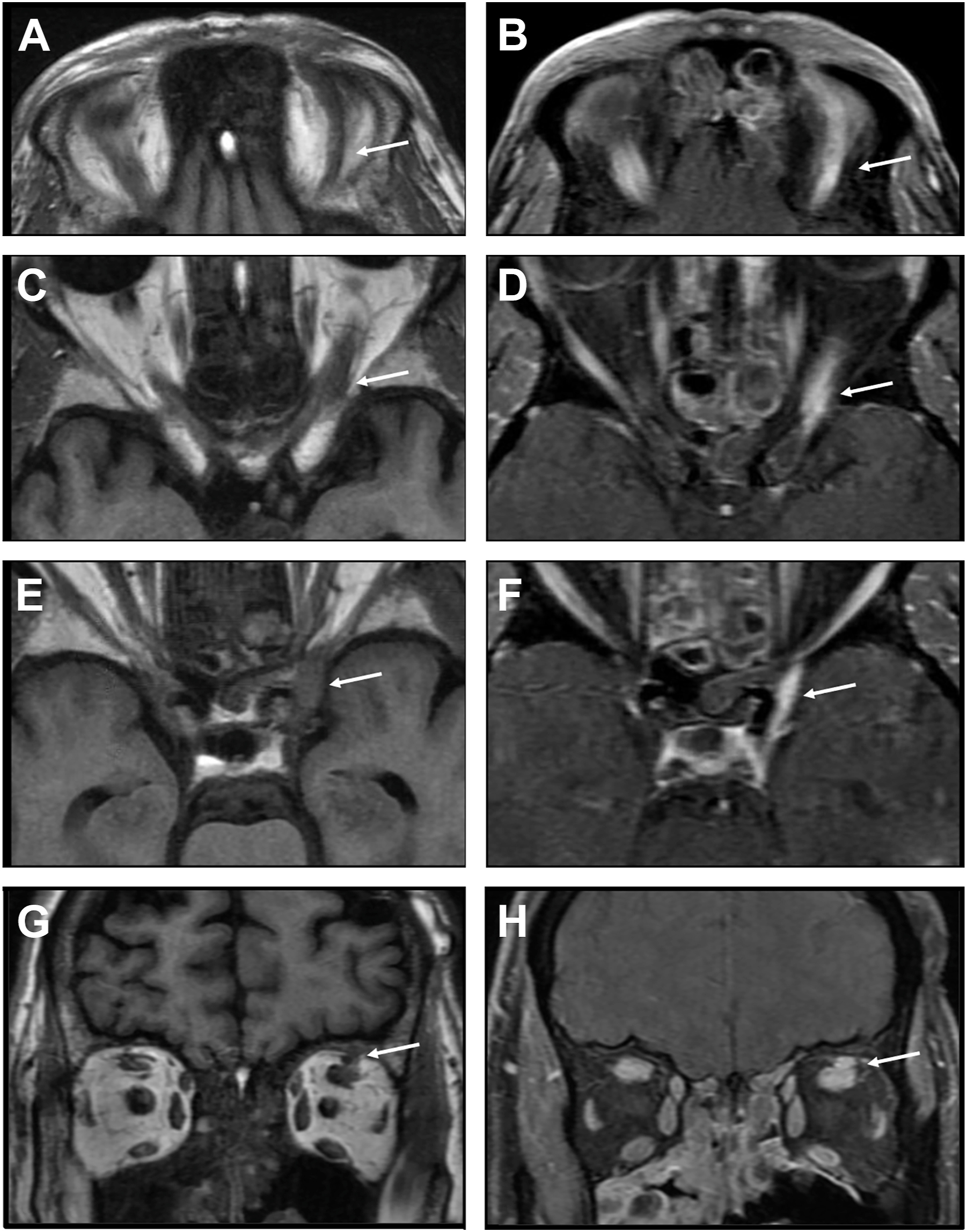A series of coronal M R I scans displays multiple musculoskeletal regions with arrows marking areas of abnormal signal intensity, likely indicating soft tissue inflammation or fluid collections.
