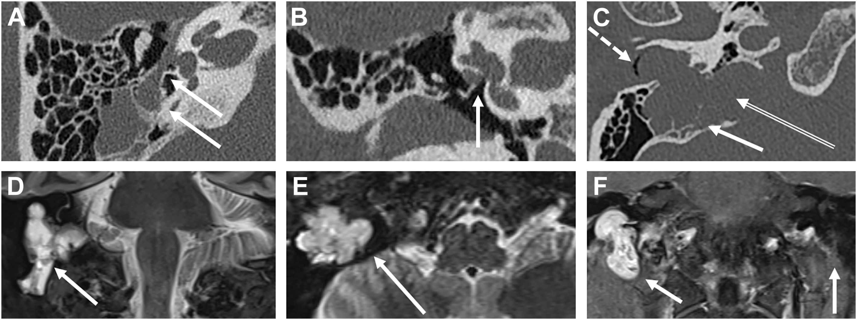 Six panels show computed tomography and magnetic resonance imaging scans showing an expansile lesion along the facial nerve pathway with bony changes and adjacent tissue involvement.