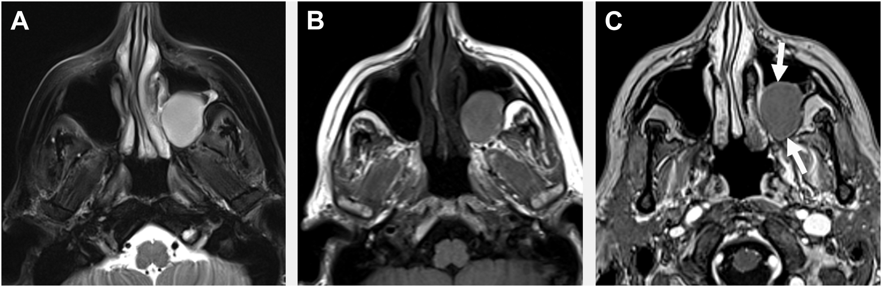 An axial series of three M R I scans displays a rounded lesion in the LEFT maxillary sinus marked with arrows.