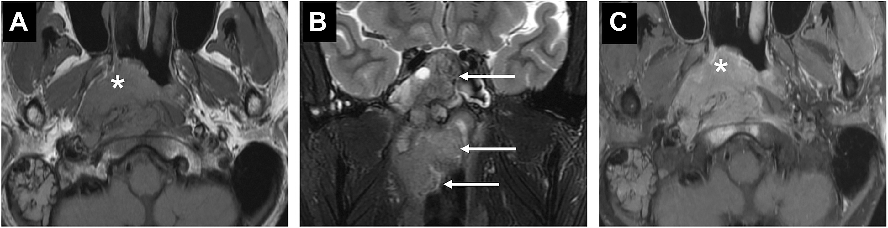 An M R I panel labeled A to C showing axial and coronal views of a nasopharyngeal mass marked by asterisks and arrows indicating extent and invasion of surrounding structures.