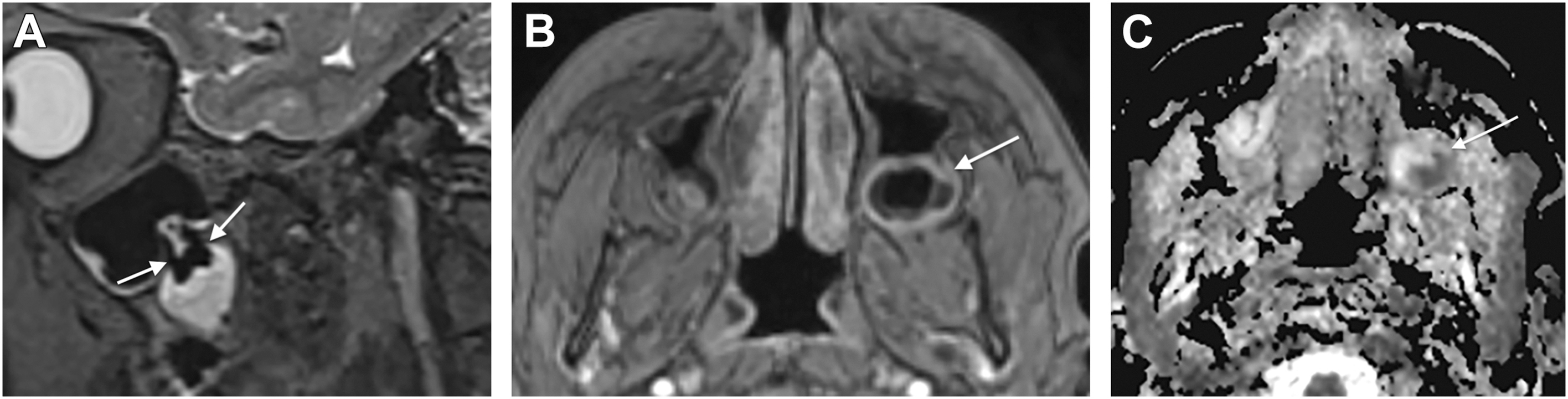 Three M R I scans show hyperintense lesions near impacted molars with well-defined boundaries and cystic characteristics.