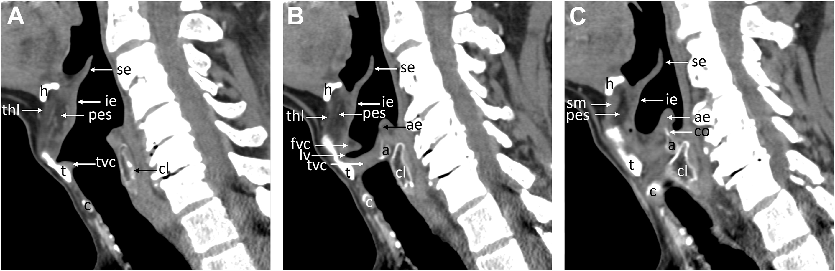 A series of sagittal C T scans of the neck has displayed labeled structures including the hyoid, epiglottis, vocal cords, trachea, and cervical vertebrae, with airway and pharyngeal regions.