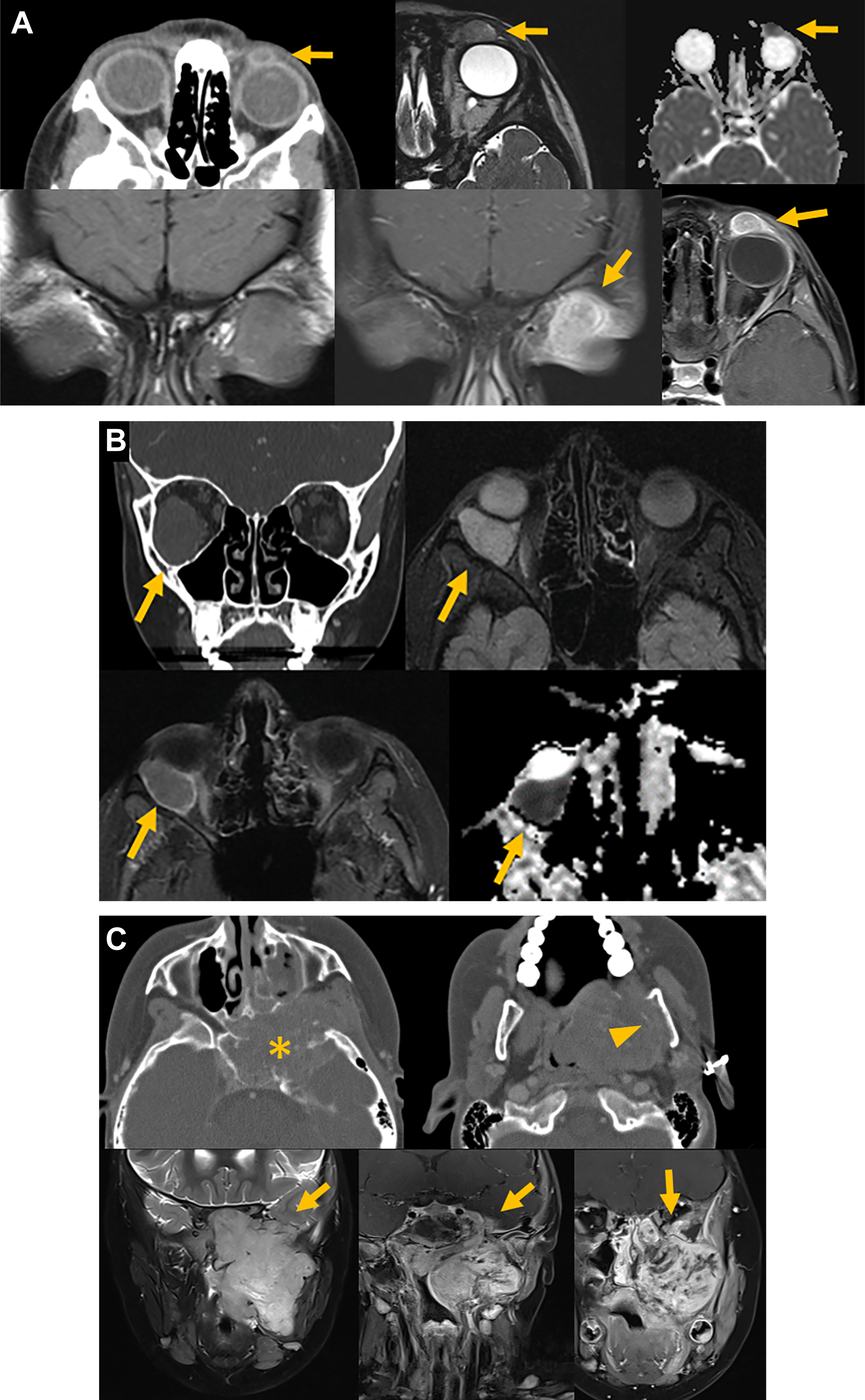 A compilation of multiple head and orbital C T and M R I scans with arrows marking orbital masses, muscle involvement, and sinus extension across different imaging planes.