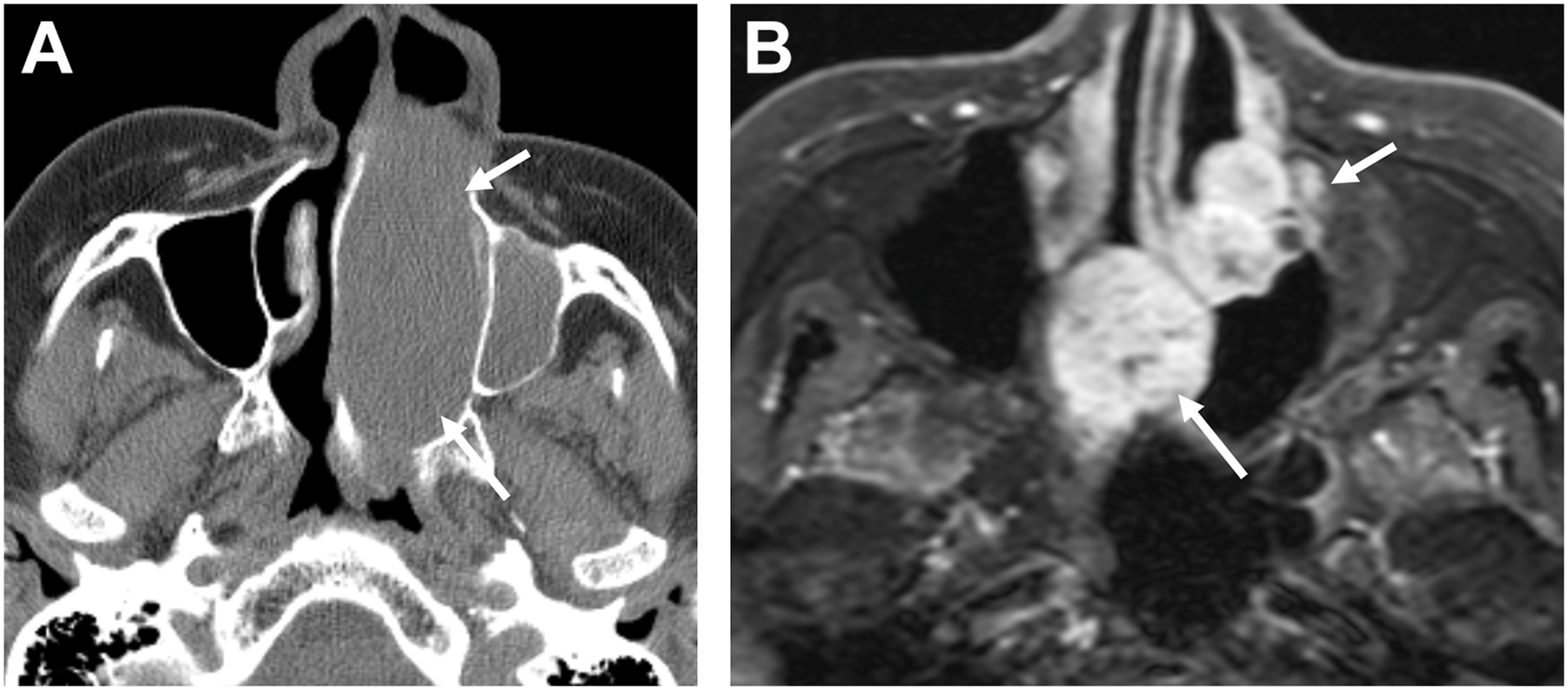 Two axial scans depict a tumor obstructing the left nasal cavity in a patient who is believed to be experiencing a tumor recurrence.