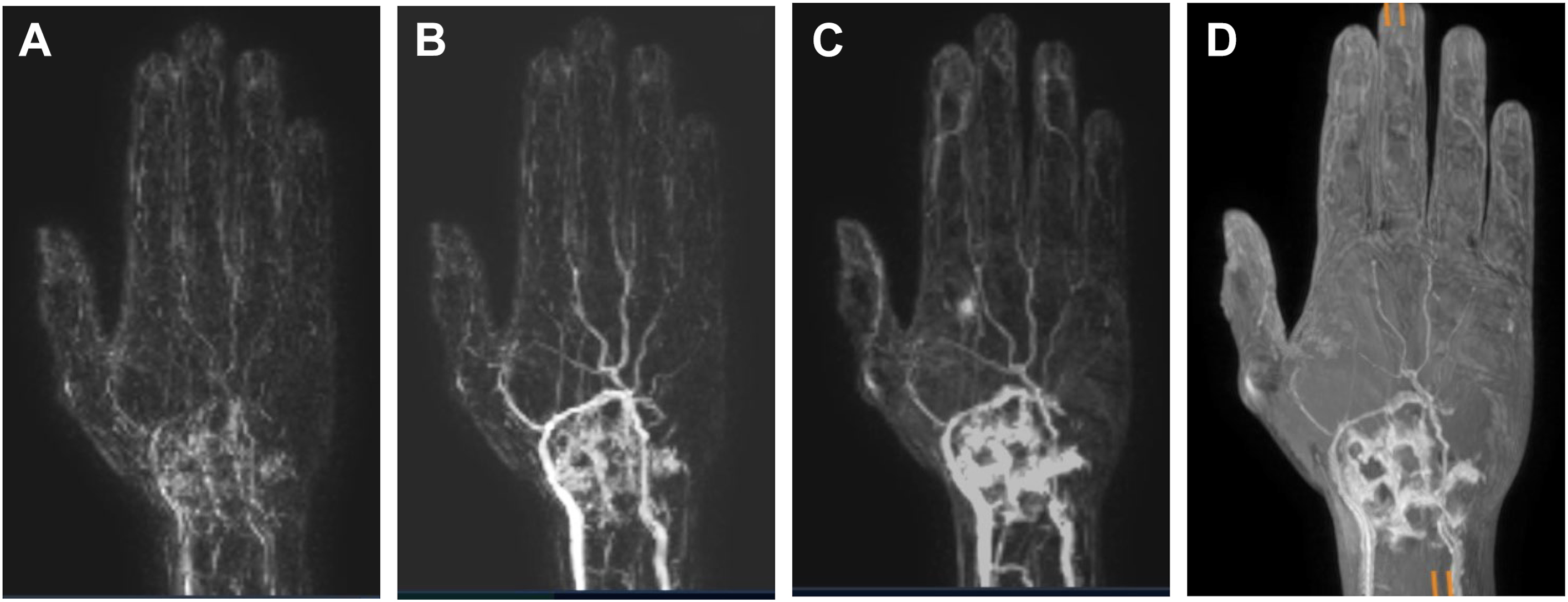 A set of four M R angiography scans, A, B, C, and D, shows rheumatoid arthritis in a wrist. The coronal scans show contrast enhancement, and the M I P scan (D) shows synovitis.