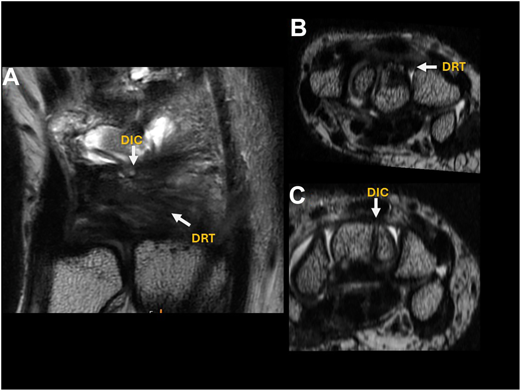 Three M R I scans of a wrist show the different dorsal ligaments in coronal and axial views.