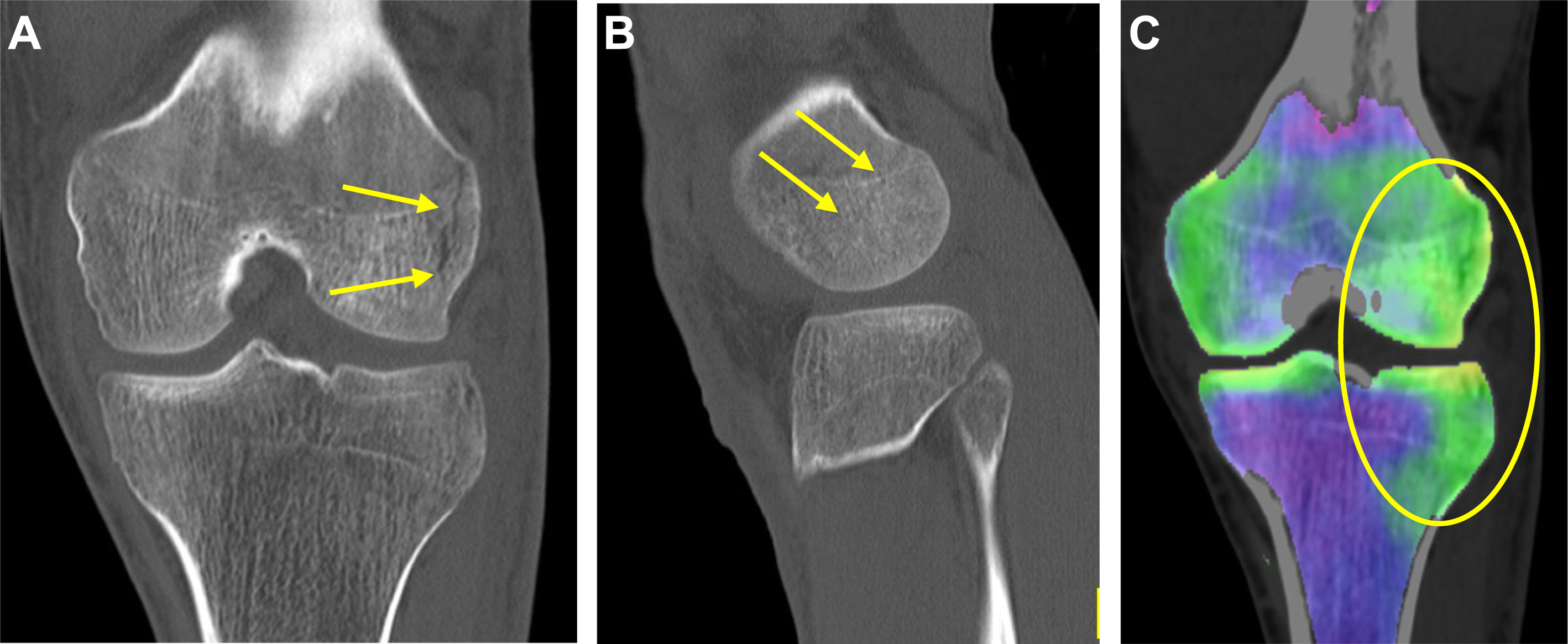 Three knee images labeled A, B, and C, showing a distal femoral fracture and bone contusion.