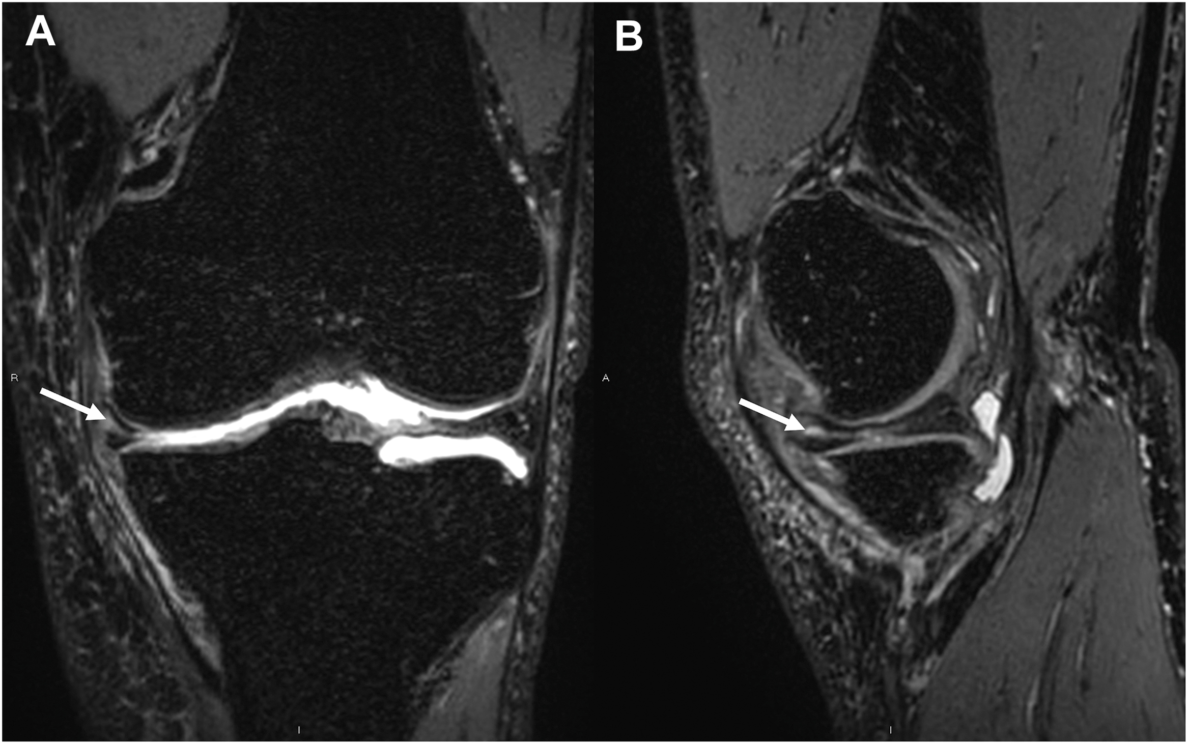A two-panel 3 D M R I of a left knee shows a horizontal tear of the medial meniscus mid-body. Panel A is a coronal view and panel B is a sagittal view, with arrows marking the tear.