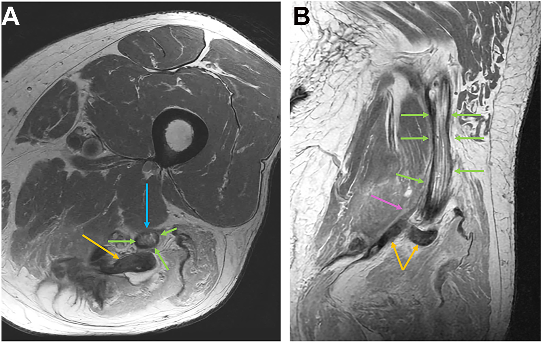 A two-panel M R I scan, A and B shows retracted hamstring tendons, a thick band of scar, and a sciatic nerve tethered by a peripheral rim of scar.