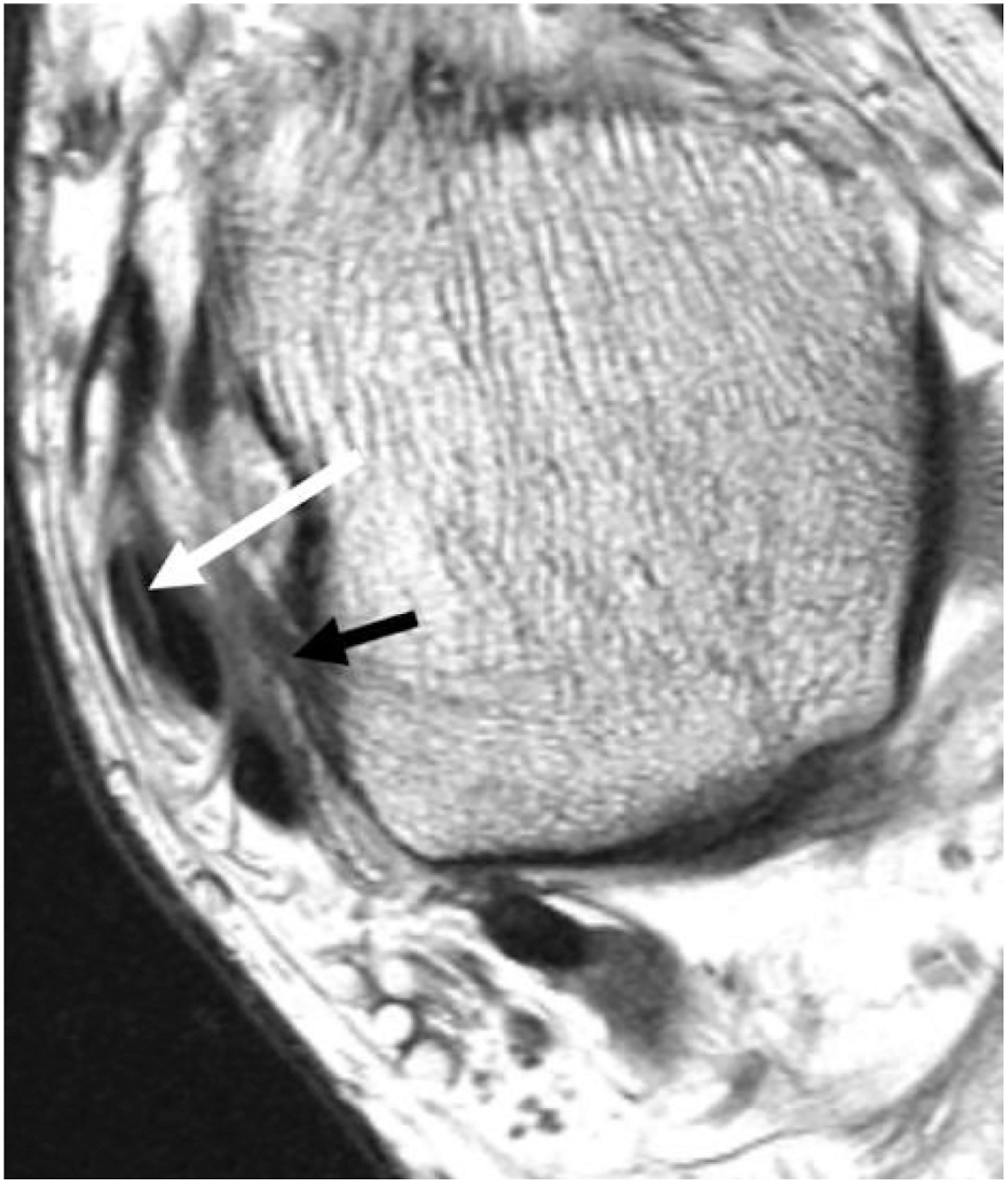 An axial P D M R I scan shows an interstitial tear of the P T T. An arrow points to the deep posterior deltoid fibers, and another arrow points to the P T T.
