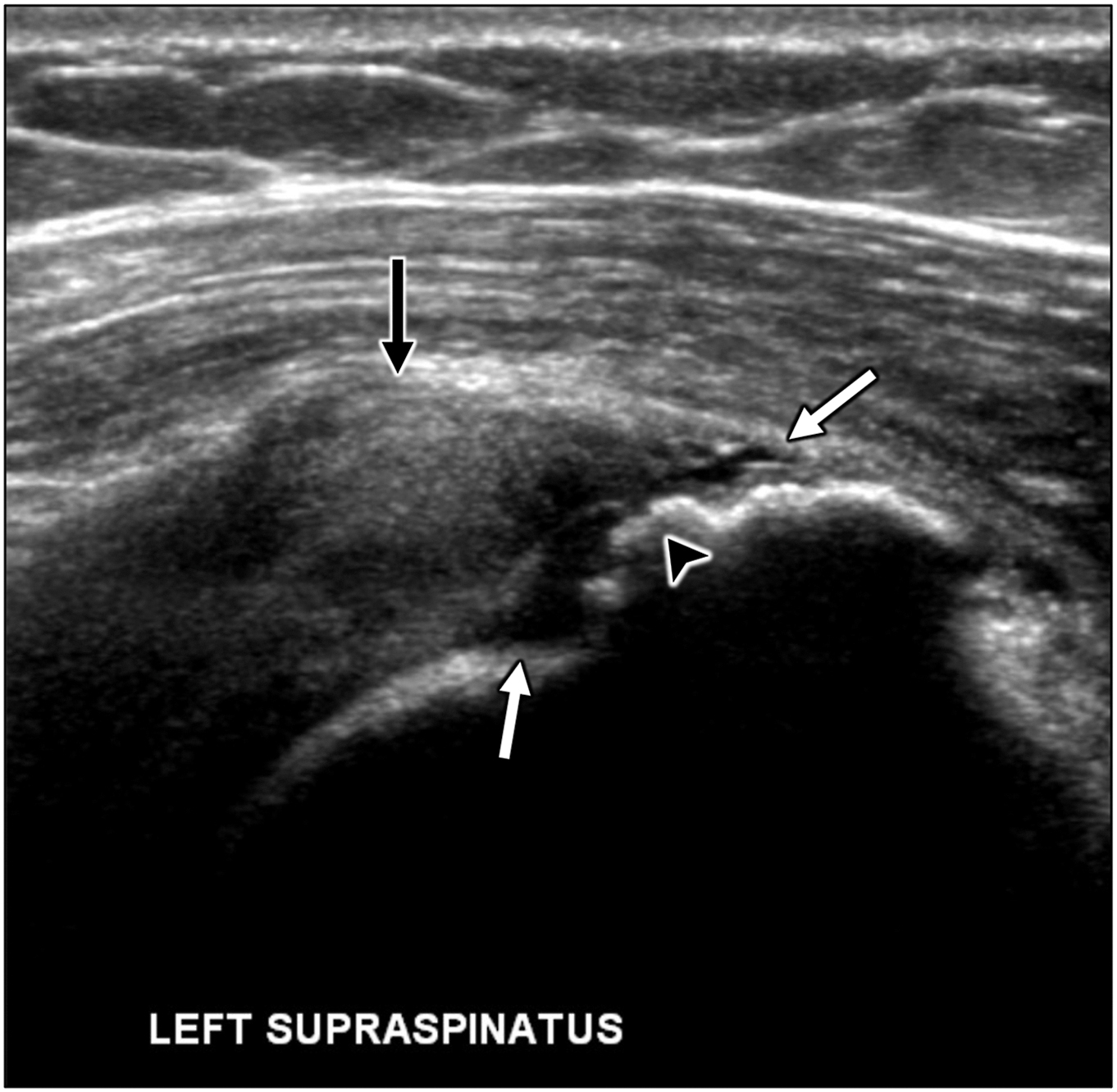 An ultrasound scan of the left supraspinatus shows severe supraspinatus tendinosis and a superimposed near full thickness tear, with arrows marking the enlarged tendon and fluid at the footprint.