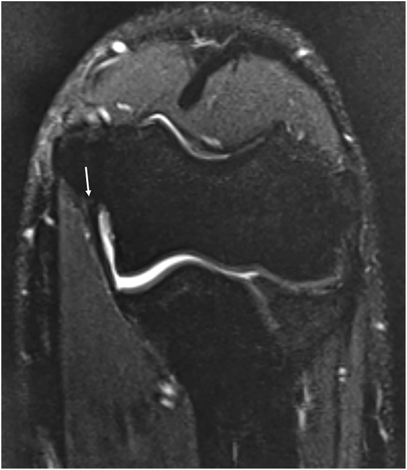 An M R I scan shows a flexed elbow with a ligament in the long axis and an arrow pointing to the humeral attachment.