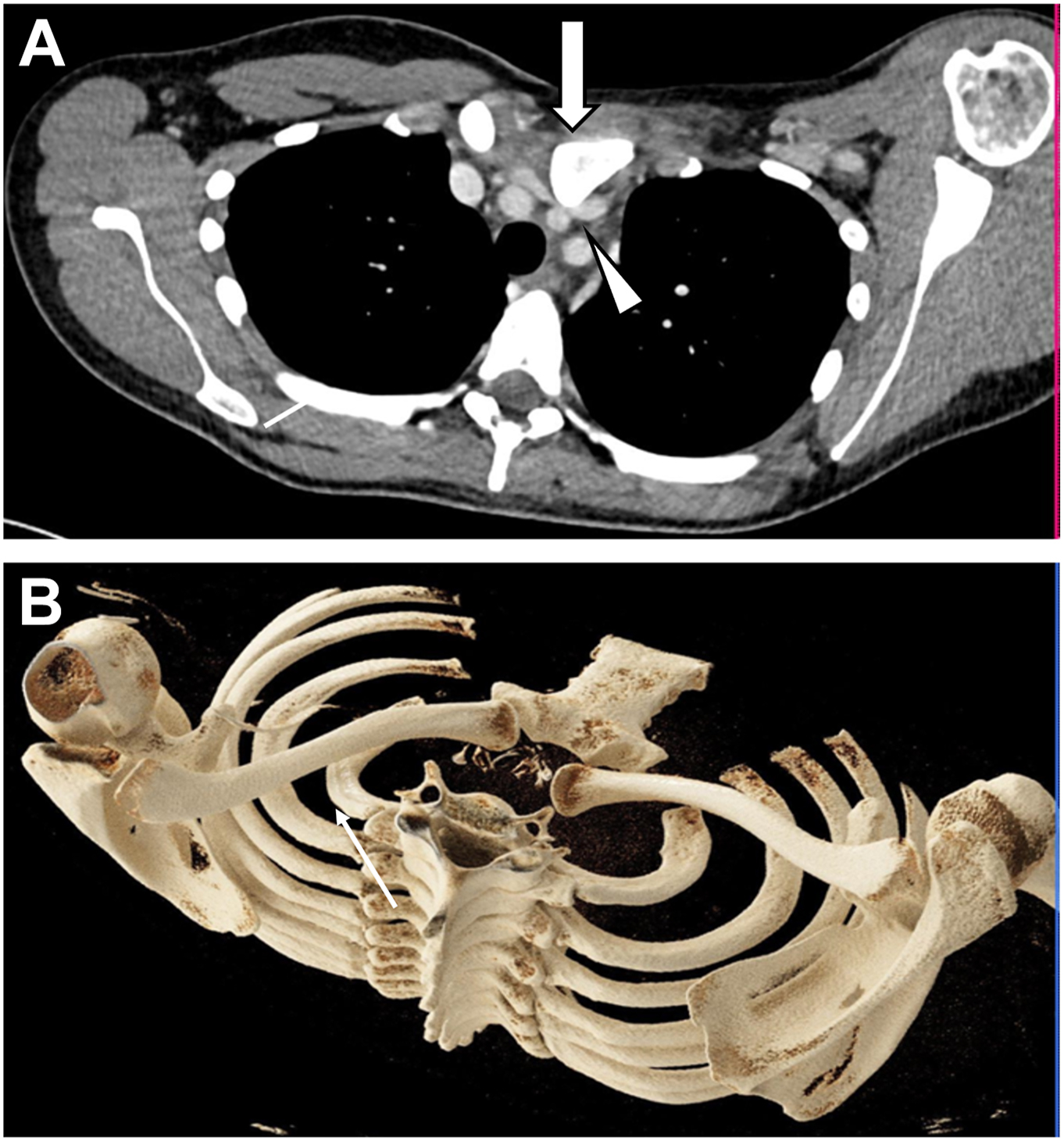 A chest scan shows a backward shift of the left collarbone head with pressure effect over a major vessel after contact injury.