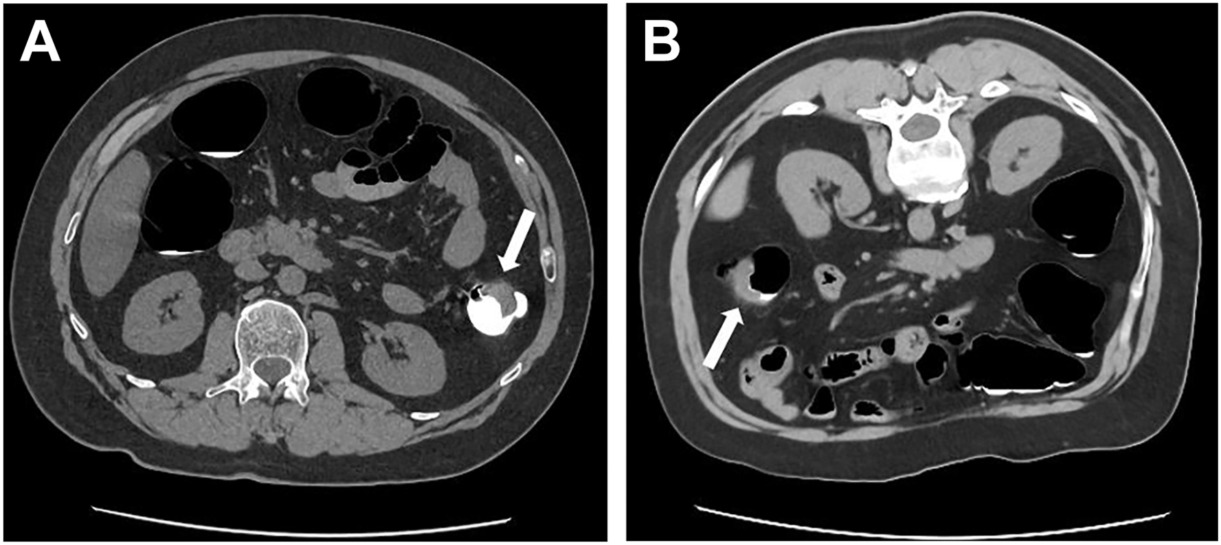 A two-panel axial C T colonography in supine and prone positions shows a 2.2-centimeter semiannular mass in the mid-descending colon of a 48-year-old male, indicated by arrows.