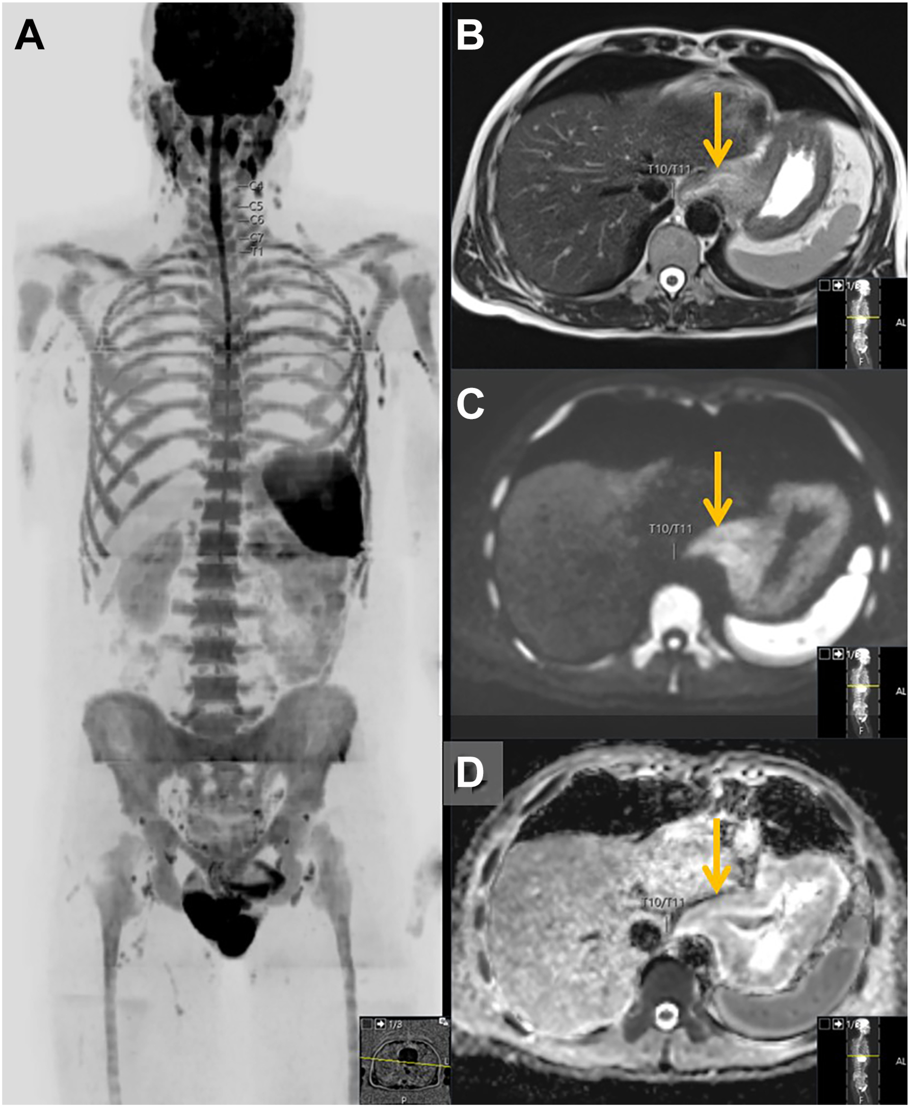 Four-panel medical imaging study of a 49-year-old male shows a malignant mass at the esophagogastric junction, verified by biopsy as colloid adenocarcinoma, classified as O N C O-R A D S 5.