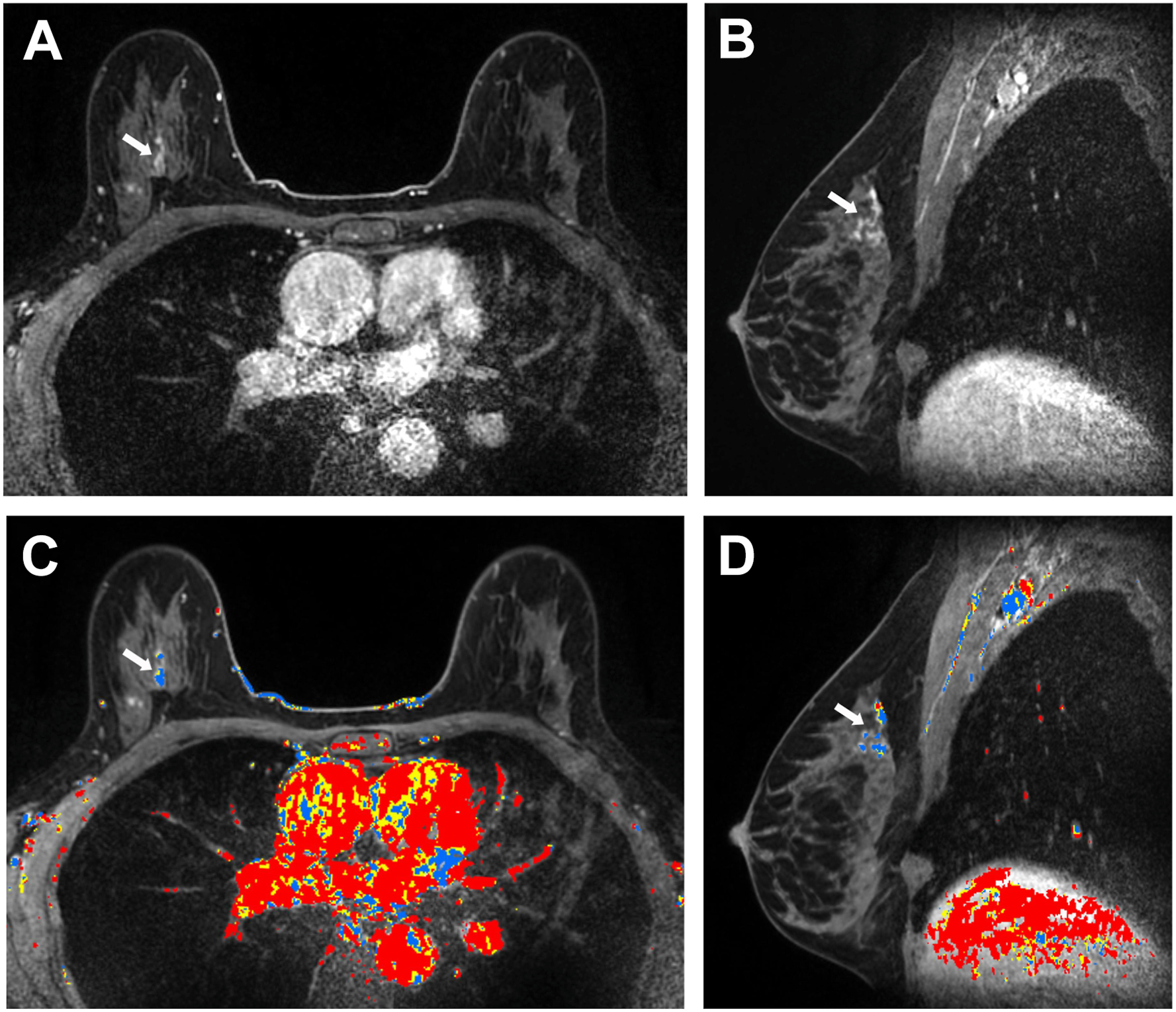 Four panels with high-risk screening breast M R I show a 28-millimeter area of non-mass enhancement in the right breast with mixed delayed kinetics, later proven grade 3 invasive ductal carcinoma.