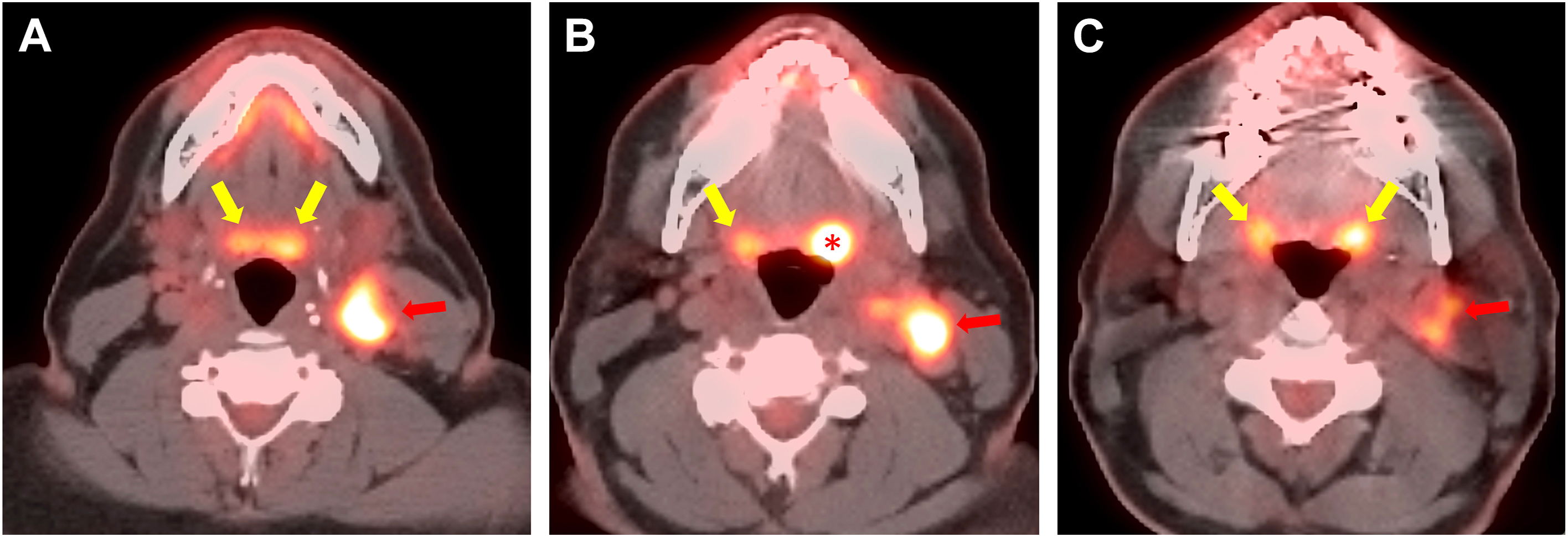Three axial positron emission tomography scans of the head and neck labeled A to C with marked areas of tracer concentration.