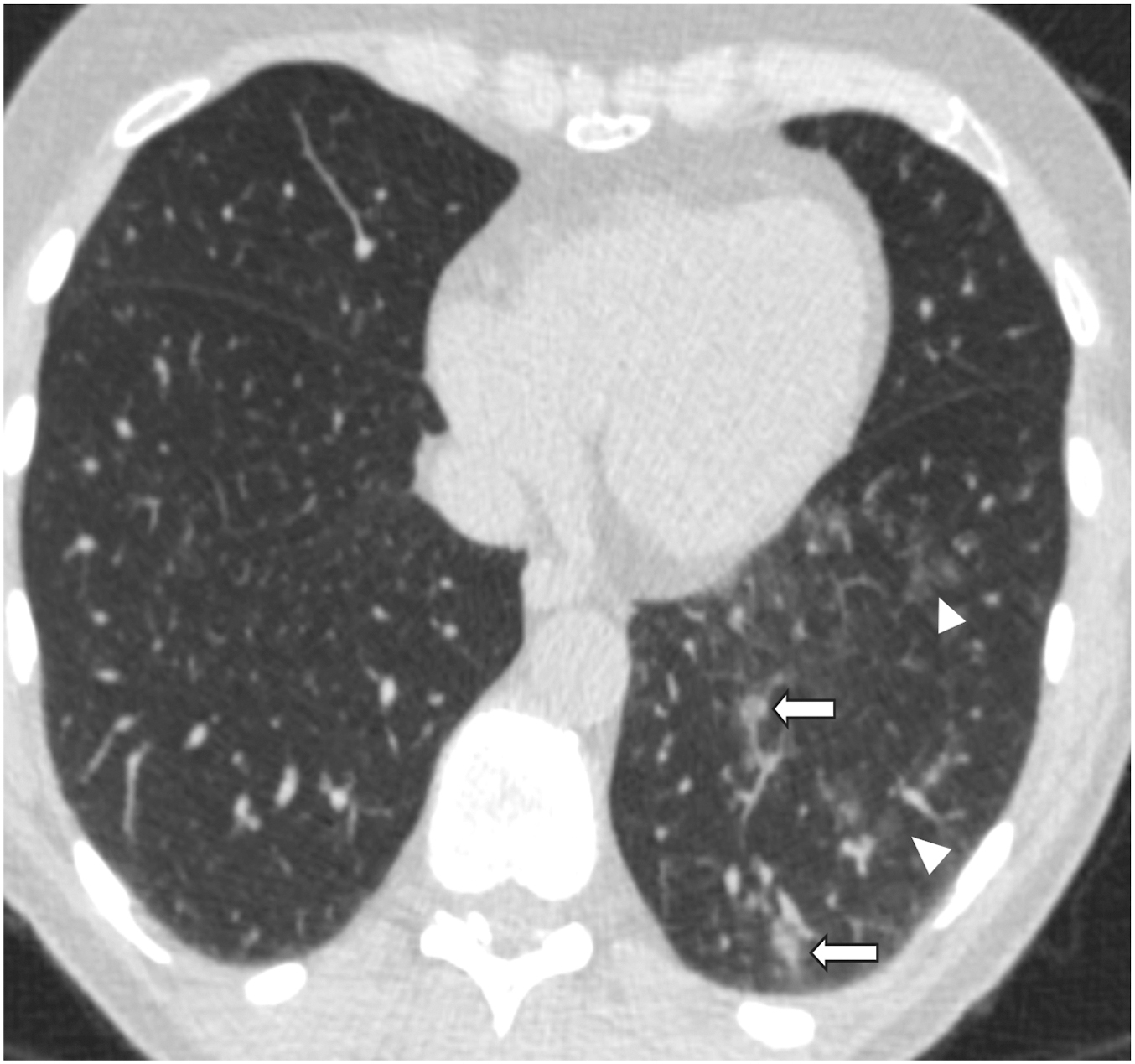 A lung-window chest C T shows small new solid nodules in the left lower lobe with surrounding ground-glass opacities, consistent with Lung-R A D S category 0 inflammatory findings.