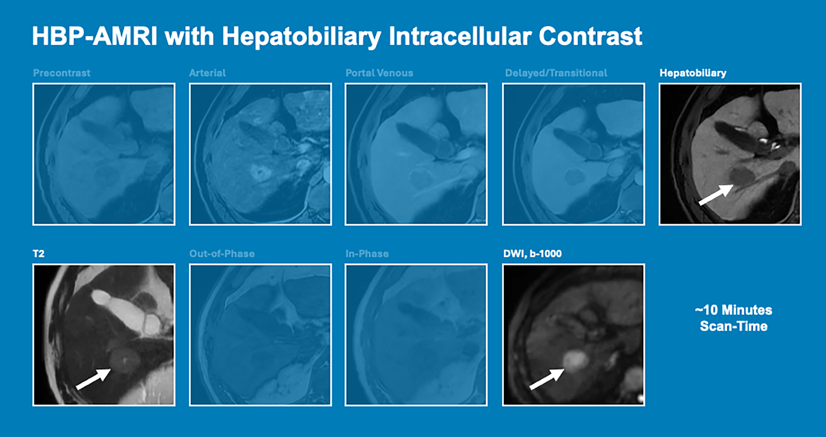 Nine panels show the H B P-A M R I protocol, which utilizes a hepatobiliary intracellular contrast agent to identify liver lesions in a significantly reduced 10-minute scan time.