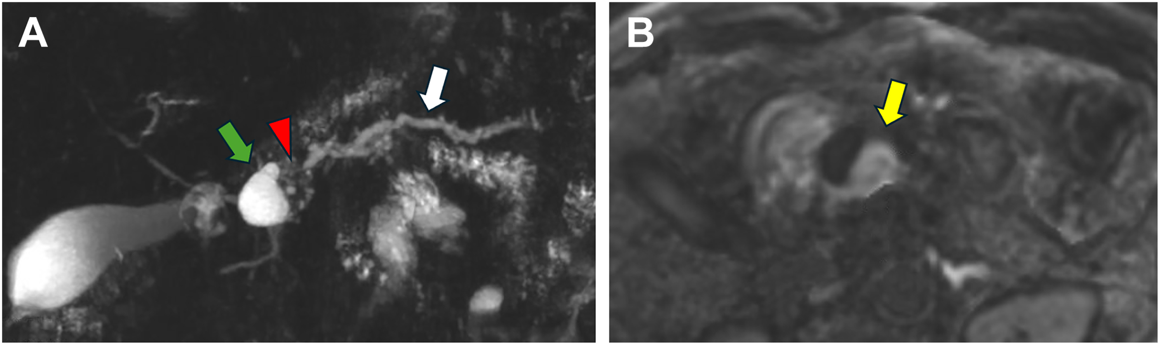 A two-panel MRCP and diffusion-weighted MRI images of a 78-year-old male with pancreatic ductal adenocarcinoma associated with intraductal papillary mucinous neoplasm (IPMN) demonstrates a pancreatic head cyst with an adjacent mass causing main pancreatic duct obstruction and upstream dilatation.