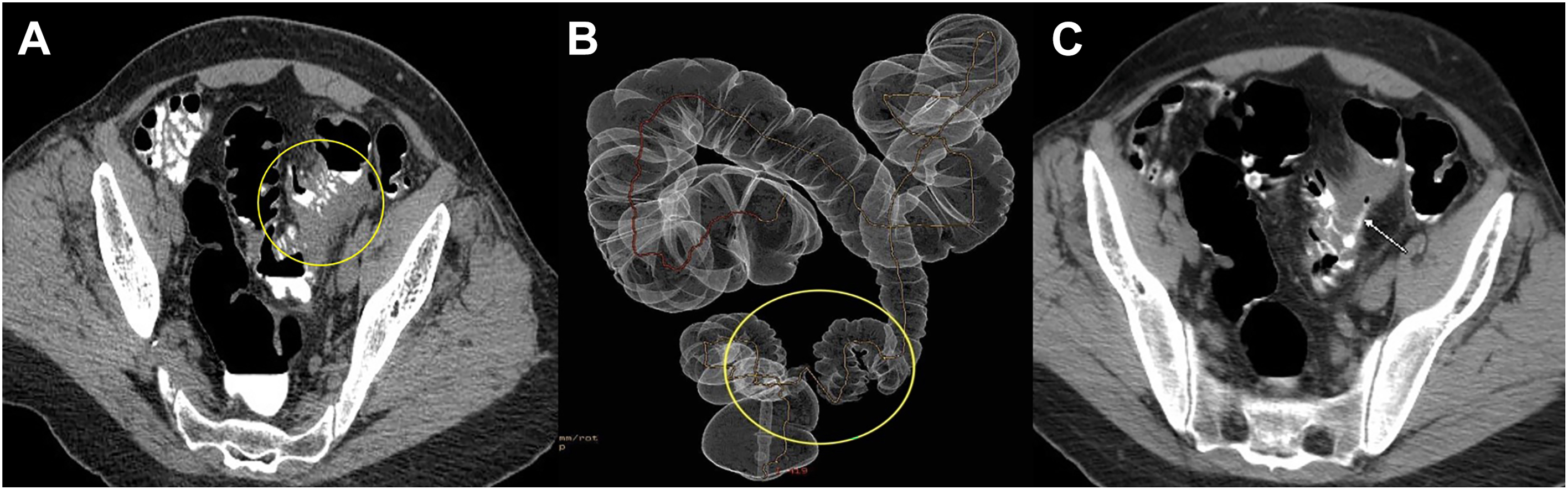 Three panels show a circumferential narrowing of the sigmoid colon in a 62-year-old male, identified via 2 D axial C T and a 3 D surface-rendered colon map.