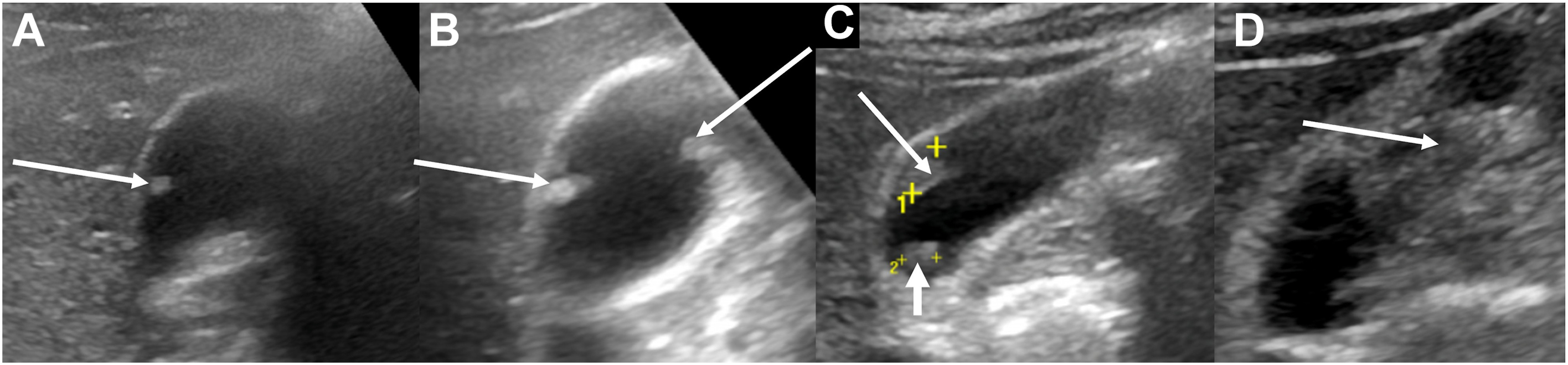 A four-panel grayscale ultrasound shows gallbladder polyps of varying sizes and morphologies used for risk stratification, with arrows.