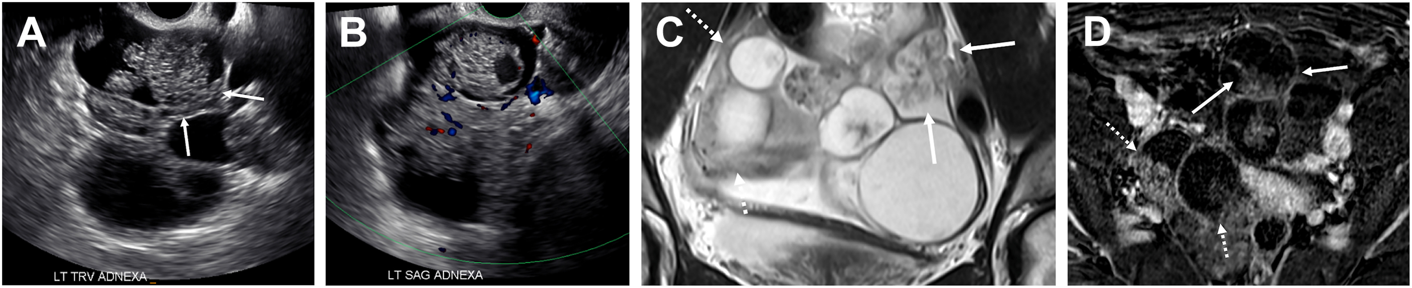 Four panels with ultrasound and M R I show bilateral 9-centimeter multilocular cystic masses with solid components and a sea anemone sign in a 39-year-old patient.