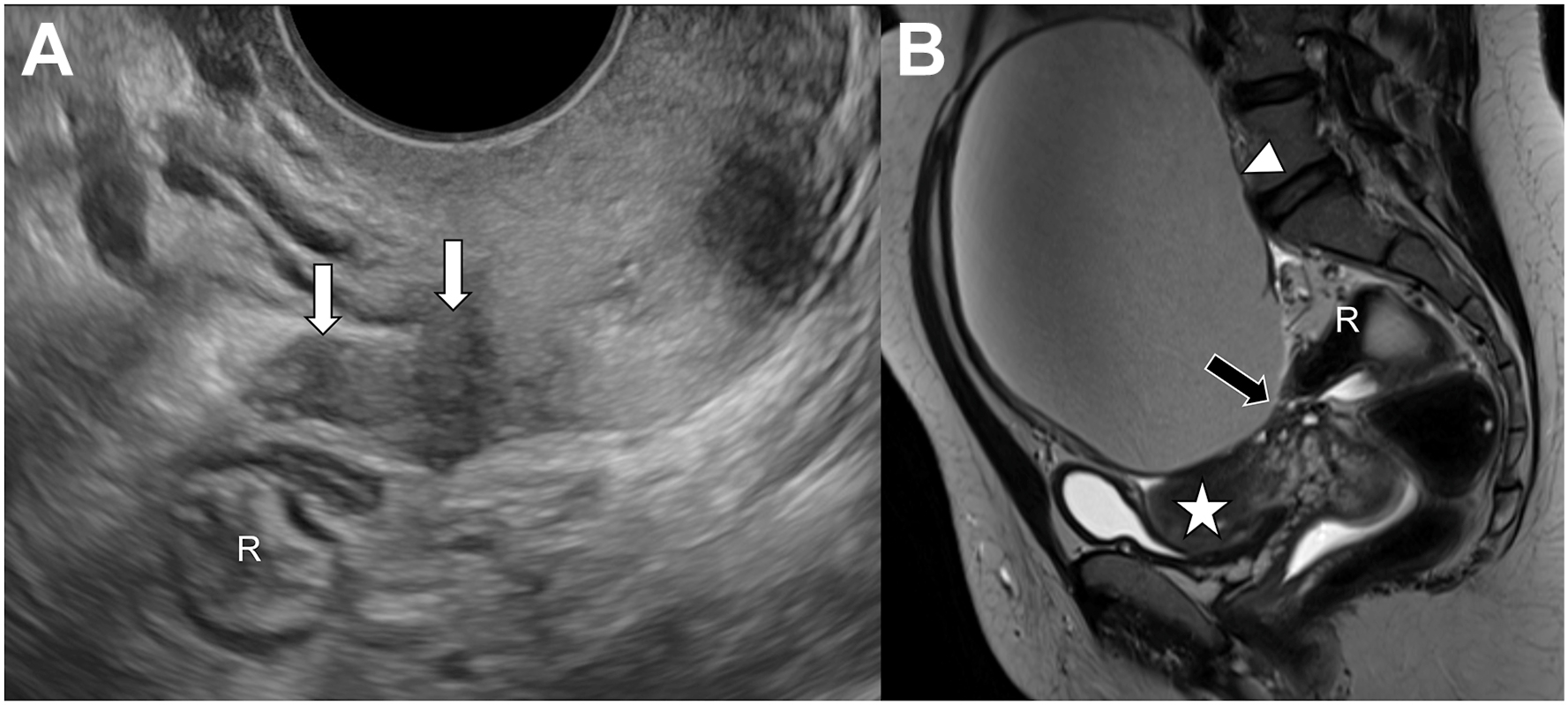 Two panels show retrocervical deep endometriosis with a hypoechoic plaque bridging the posterior cervix to the anterior rectal wall on transvaginal ultrasound and a T 2-dark plaque with tethering.