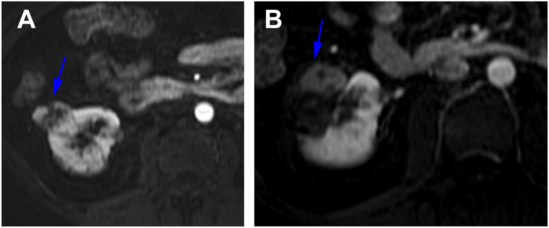 Two axial T 1-weighted M R images of a right kidney show a heterogeneously enhancing solid mass and post-ablation changes with no signs of recurrence.
