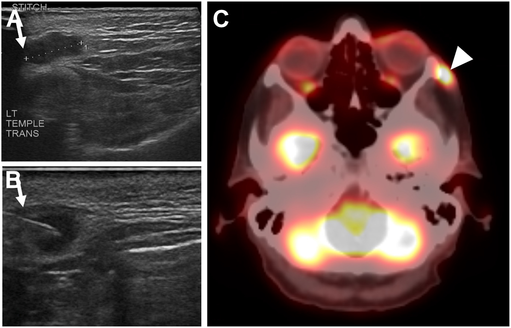 A set of three panels shows two grayscale ultrasound views and one axial color positron emission tomography computed tomography scan tracking a recurrent nodule in the left temple of a patient.