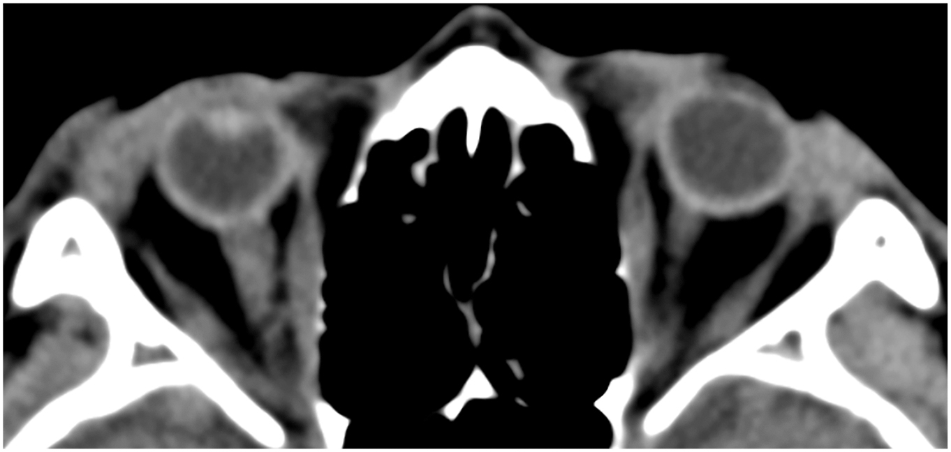 An axial unenhanced C T of the orbits shows bilaterally small globes with normal shape and contour, consistent with microphthalmia.