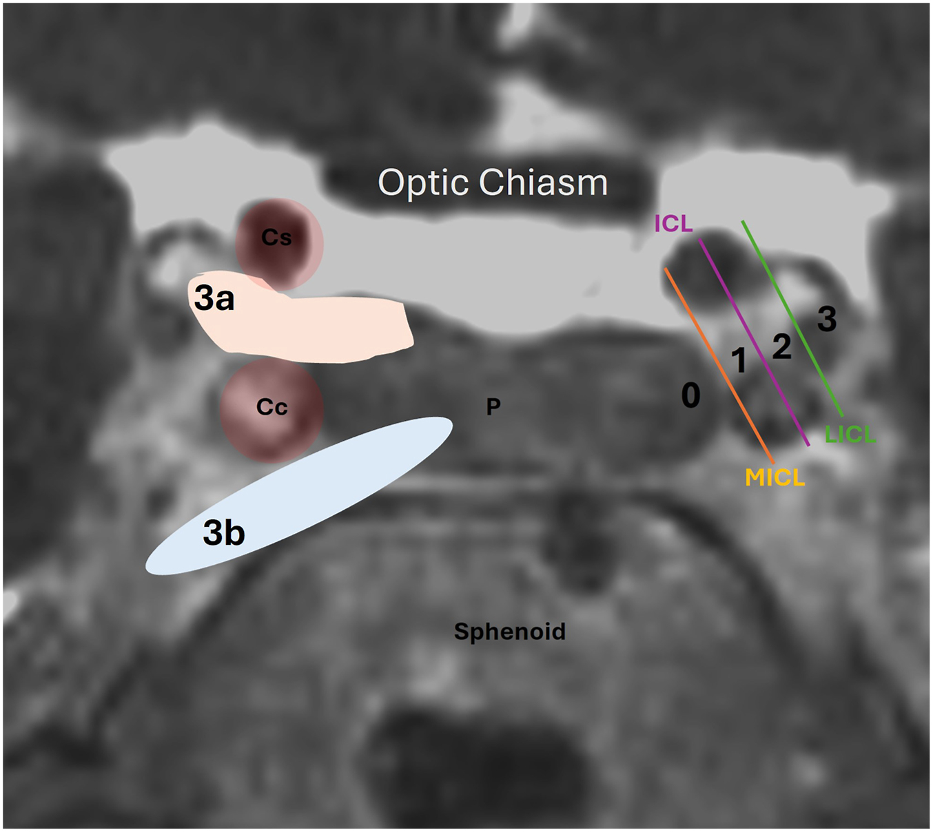 A coronal C I S S M R I shows Knops' grades 0-3 b and intercarotid lines superimposed over the pituitary gland and internal carotid arteries to classify cavernous sinus invasion.