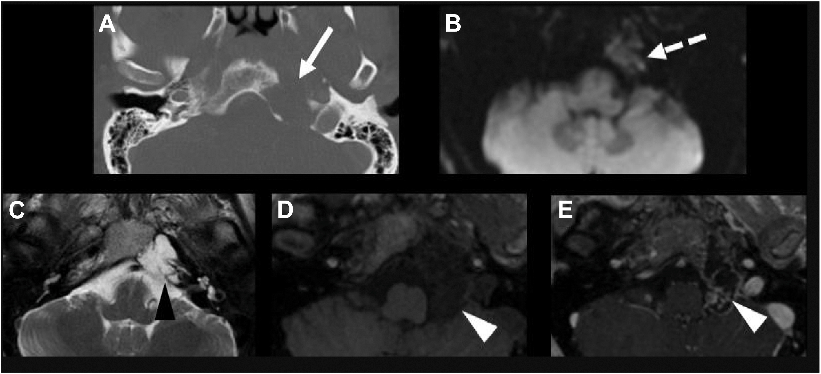 A five-panel C T and M R I of a petroclival fissure chondrosarcoma features include a destructive process, mild reduced diffusivity, T 2-hyperintensity, and mild internal contrast enhancement.